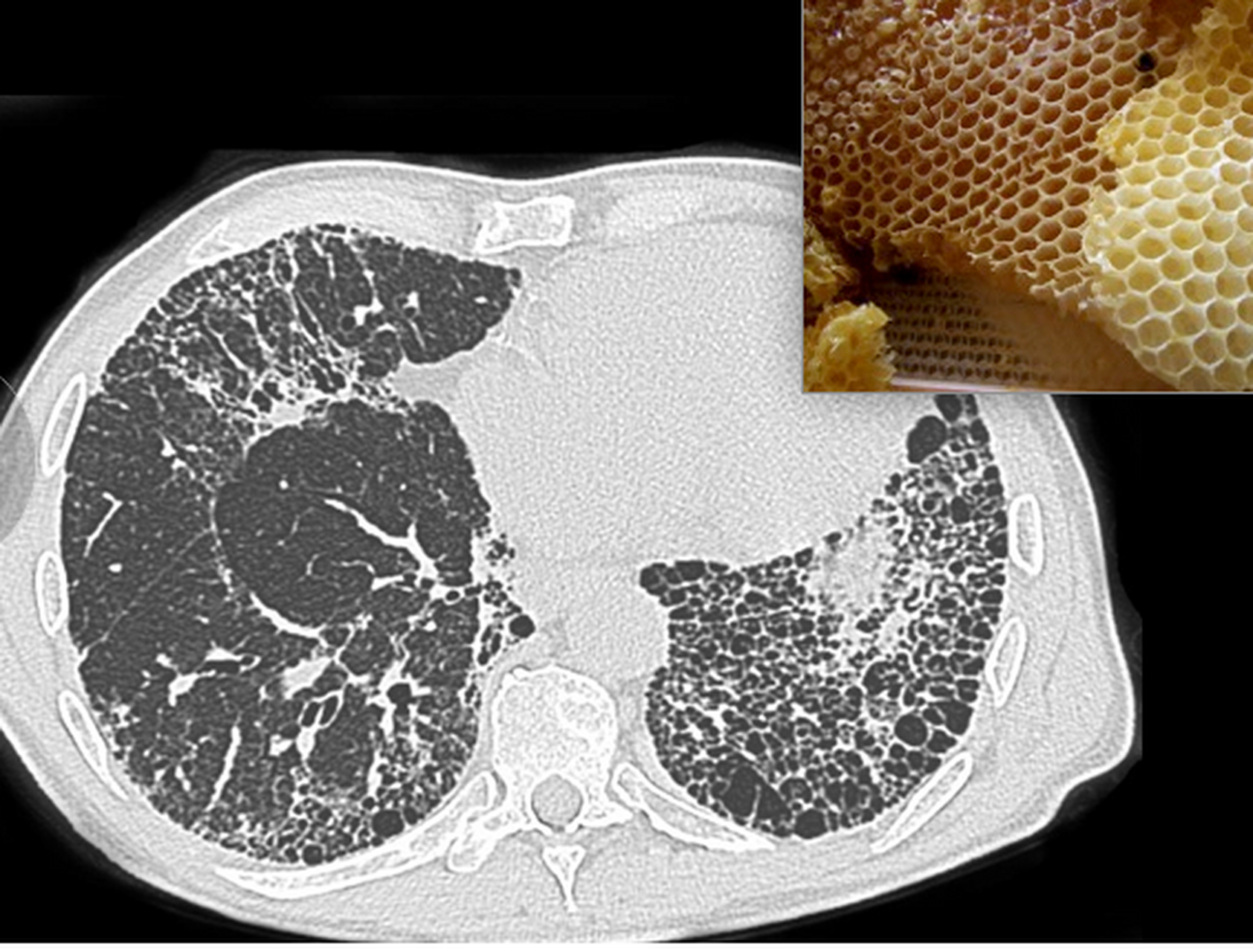 肺纤维化和正常肺图片图片