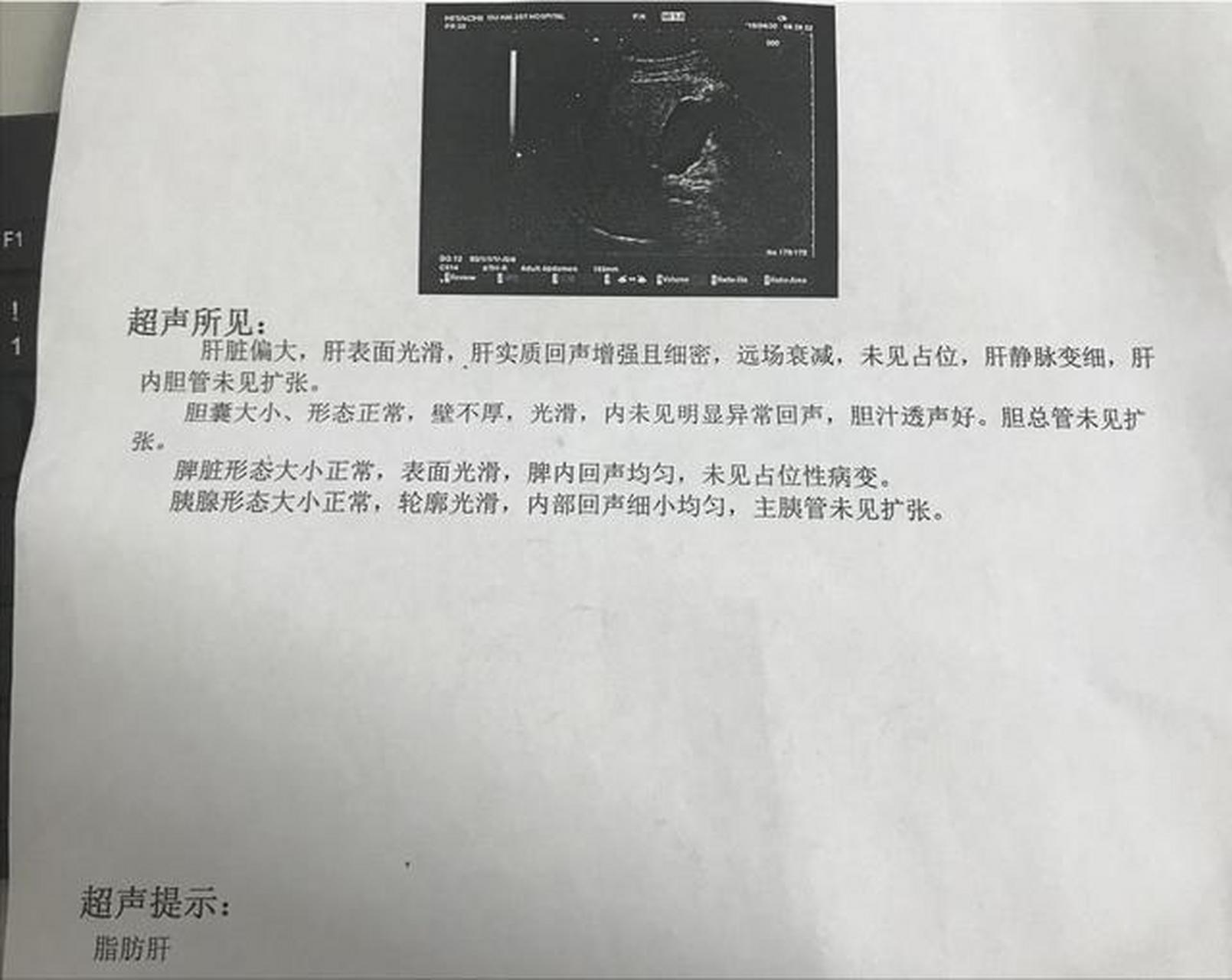 肝硬化彩超表现图片