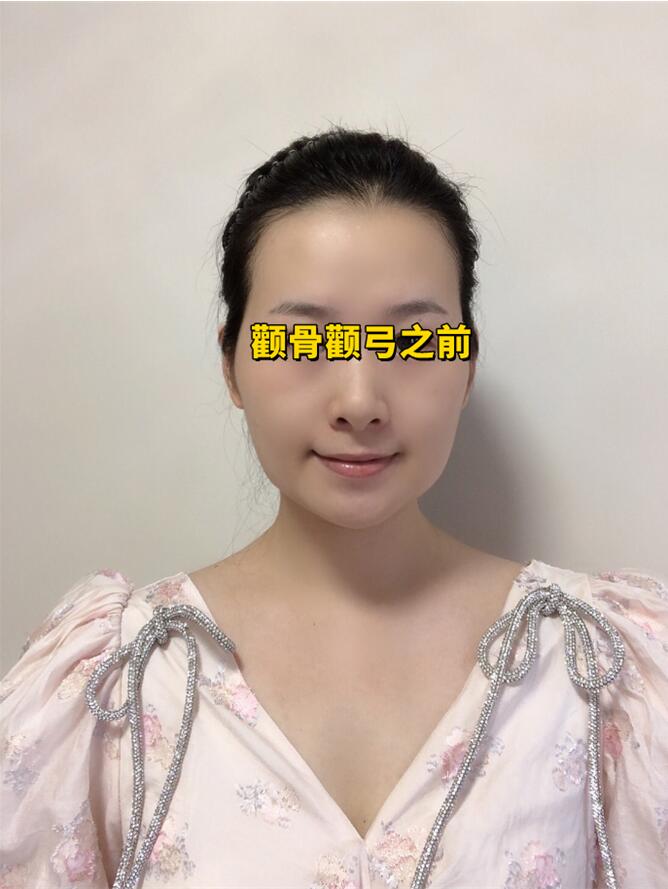 颧骨高是哪个部位图片颧弓外扩正面怎么看颧弓外扩是啥样的颧弓外扩ct