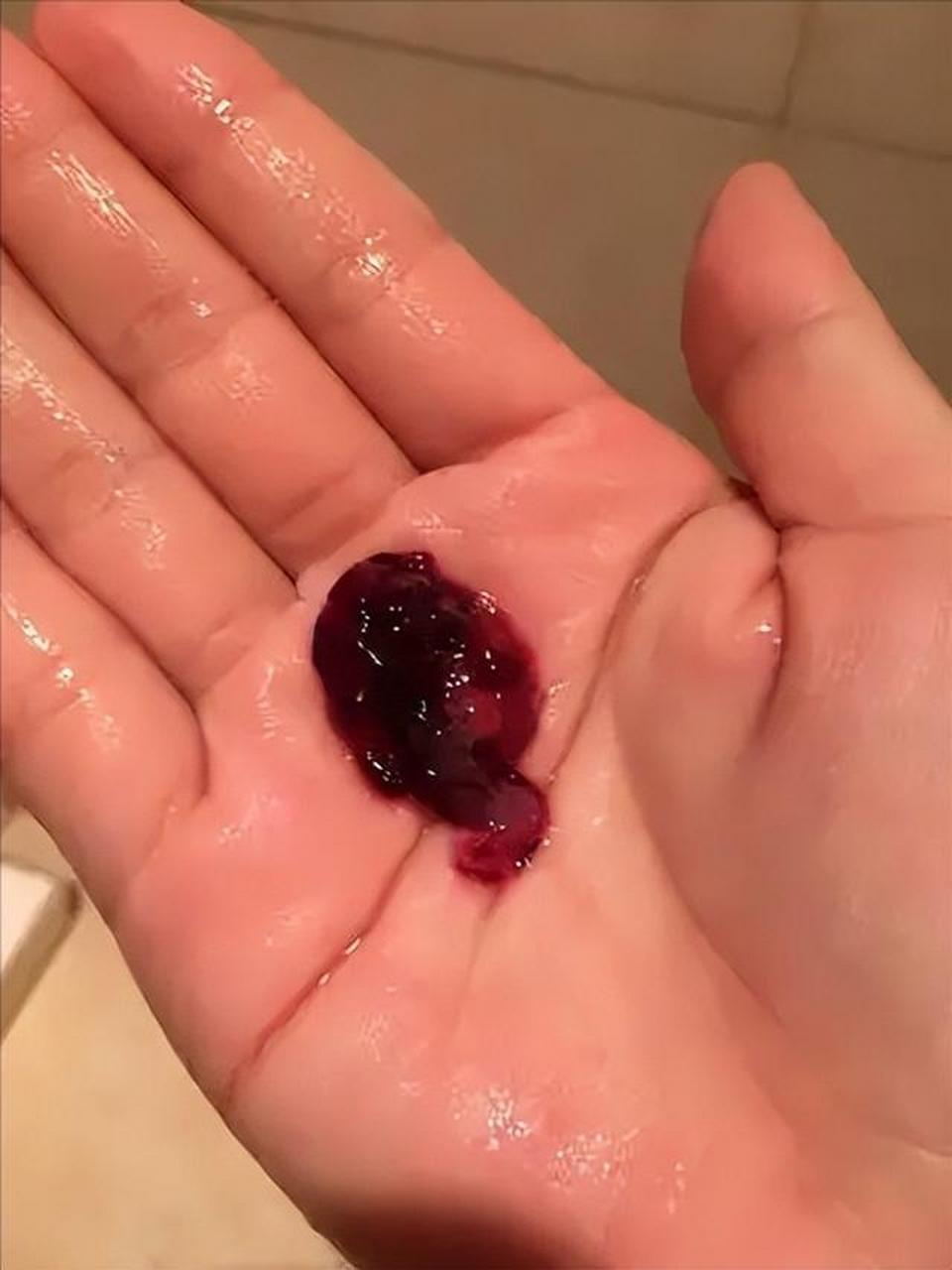 生化妊娠也是一种怀孕,它只不过是怀孕的状态,只是血里边产生了cgg