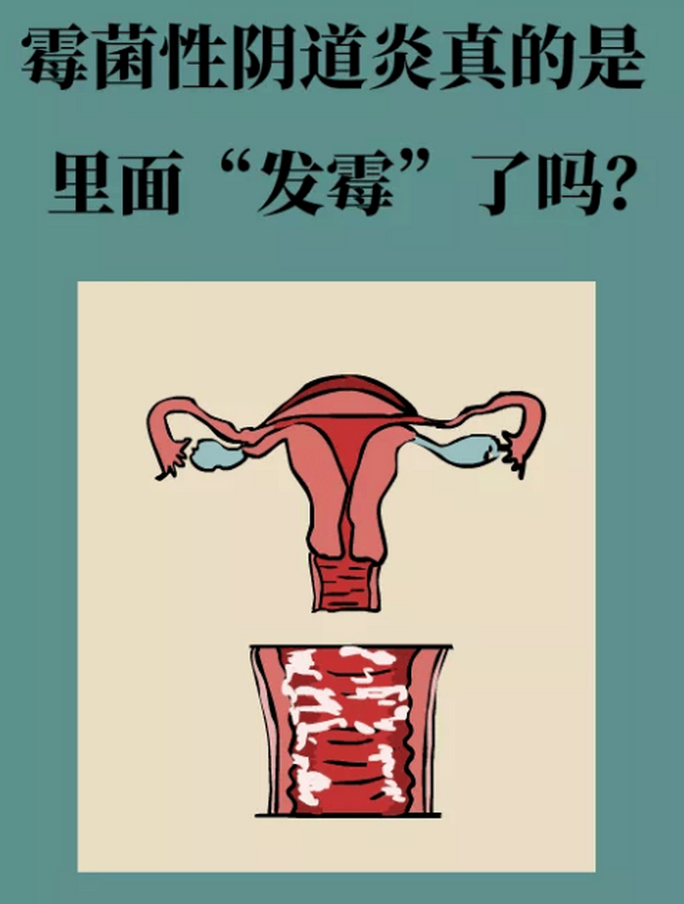 流行病学显示,大约有70%的女性,一生中至少会得一次霉菌性阴道炎.