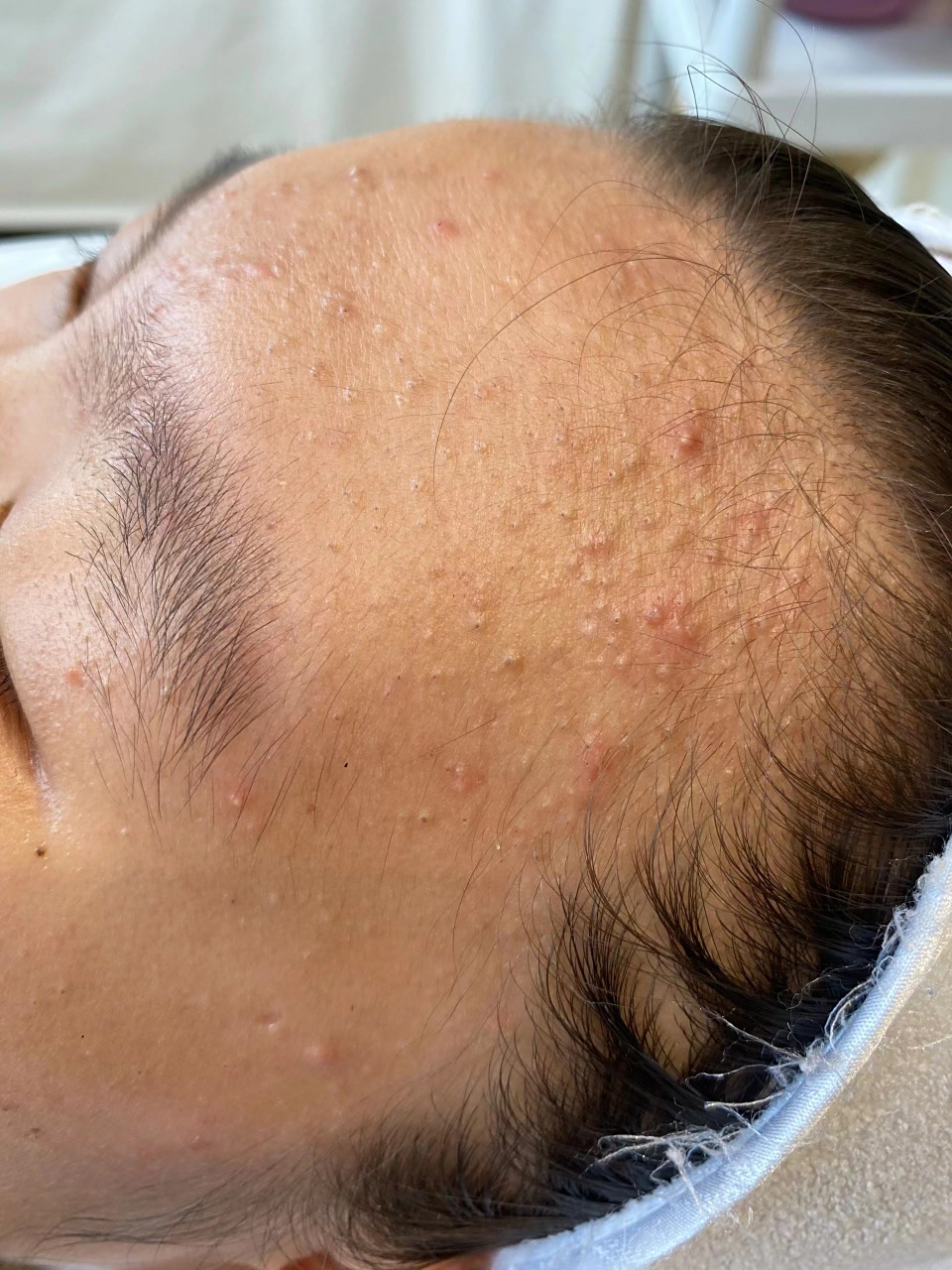 才12岁的女孩,额头长满闭口,父母从简阳带过来找我看