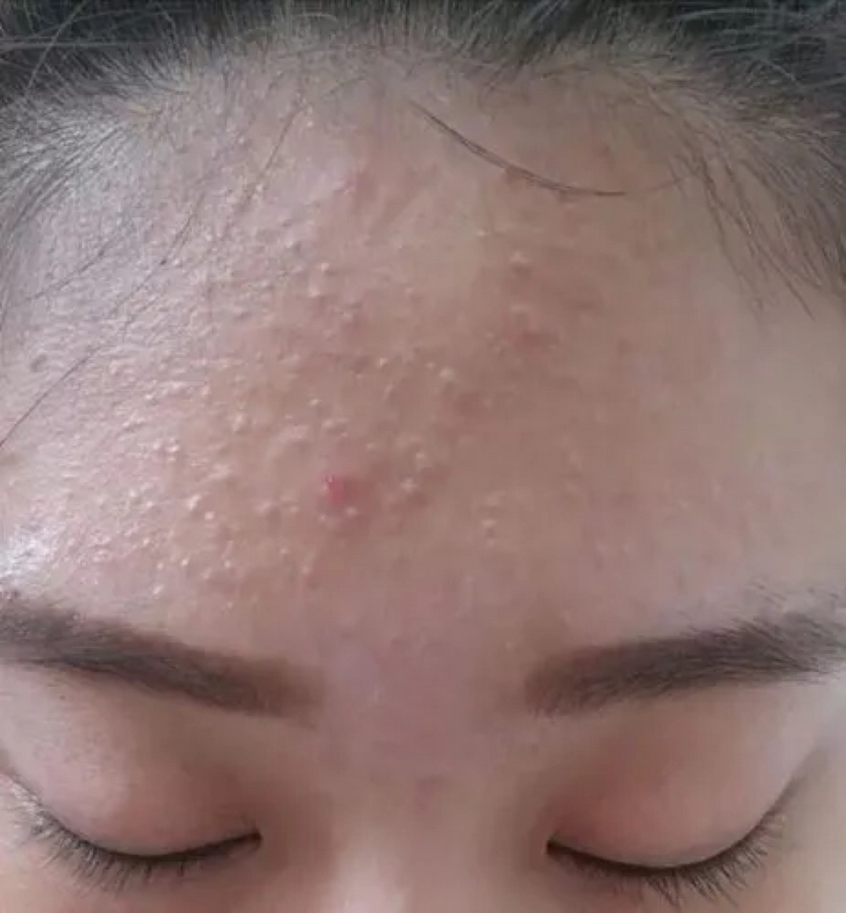 毛囊炎怎么治才能除根脸上的痘痘?