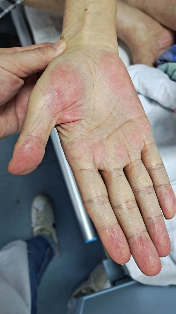 比较典型的肝掌了,大小鱼际绯红,就像高原地区颧骨上的"高原红"的颜色