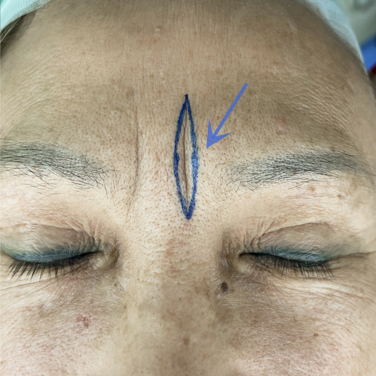 "#川字纹# 切除不留疤,骗人的!" 手术没有丝毫痕迹,是根本不可能的.