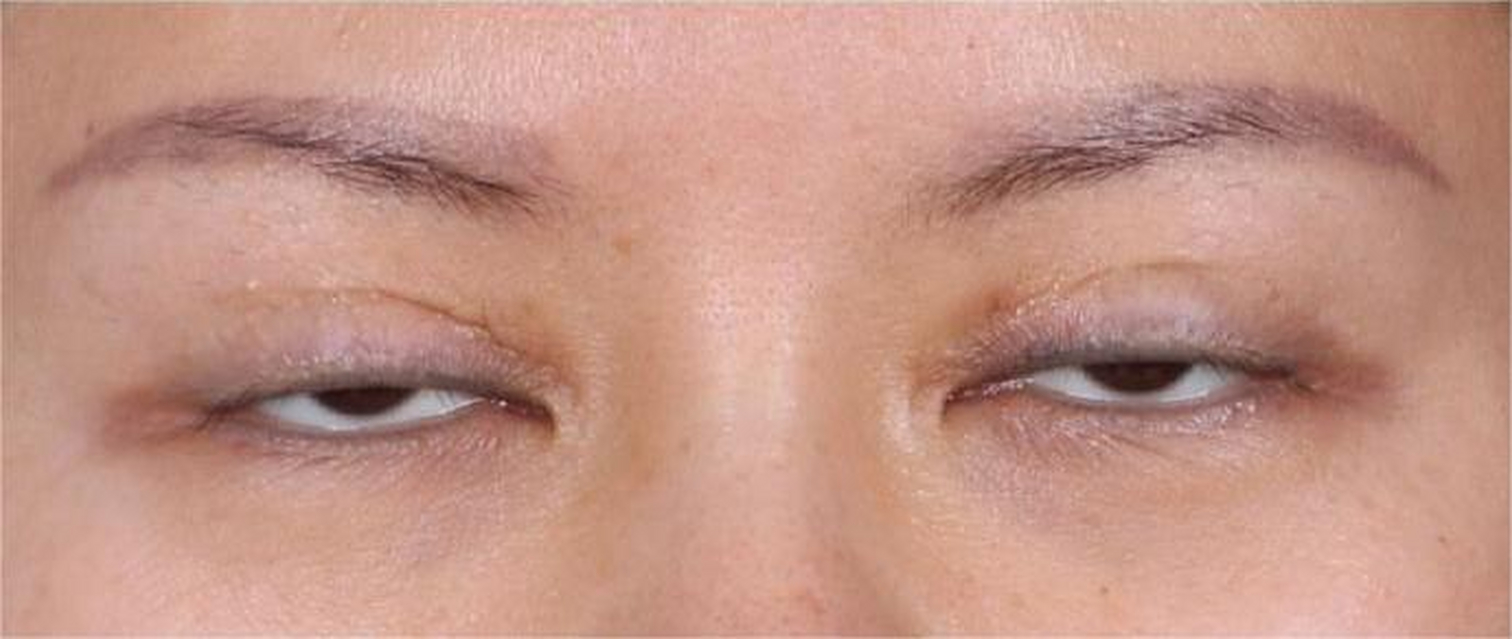 双眼皮术后闭眼不全可以考虑这三个情况:  1.