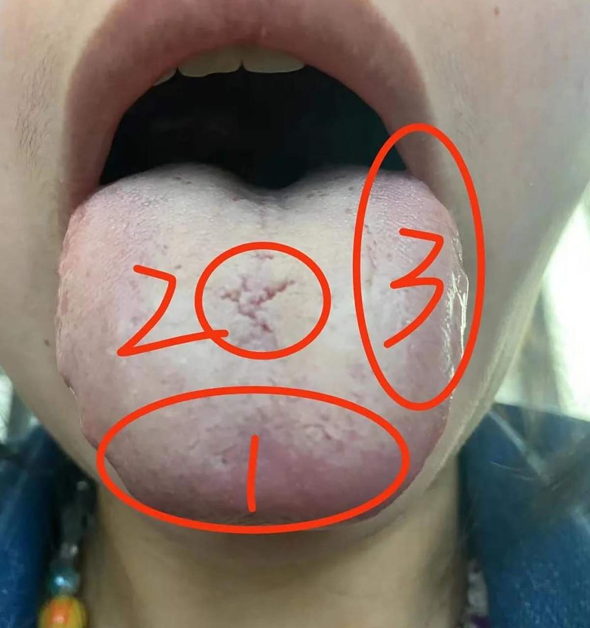 痰湿的症型 所以他出现了嘴巴黏,头昏沉,容易贪睡,腹胀等等这样的症状