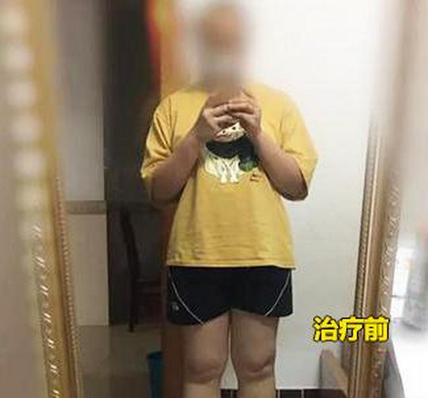 甲减发展到后期,症状有多严重?