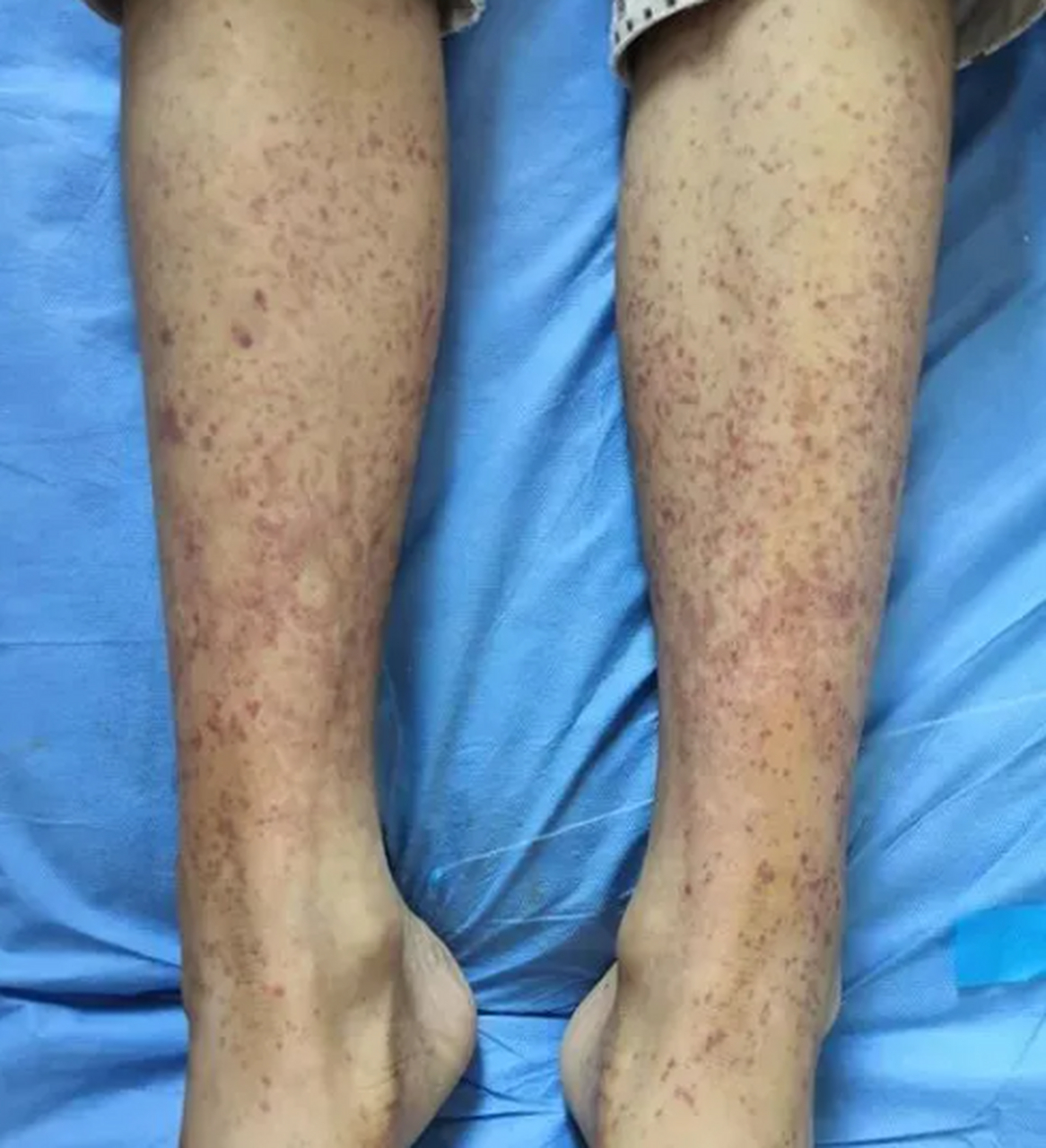 大家好,我是血液科肖医生[爱你]~血小板减少性紫癥与过敏性紫癜如何