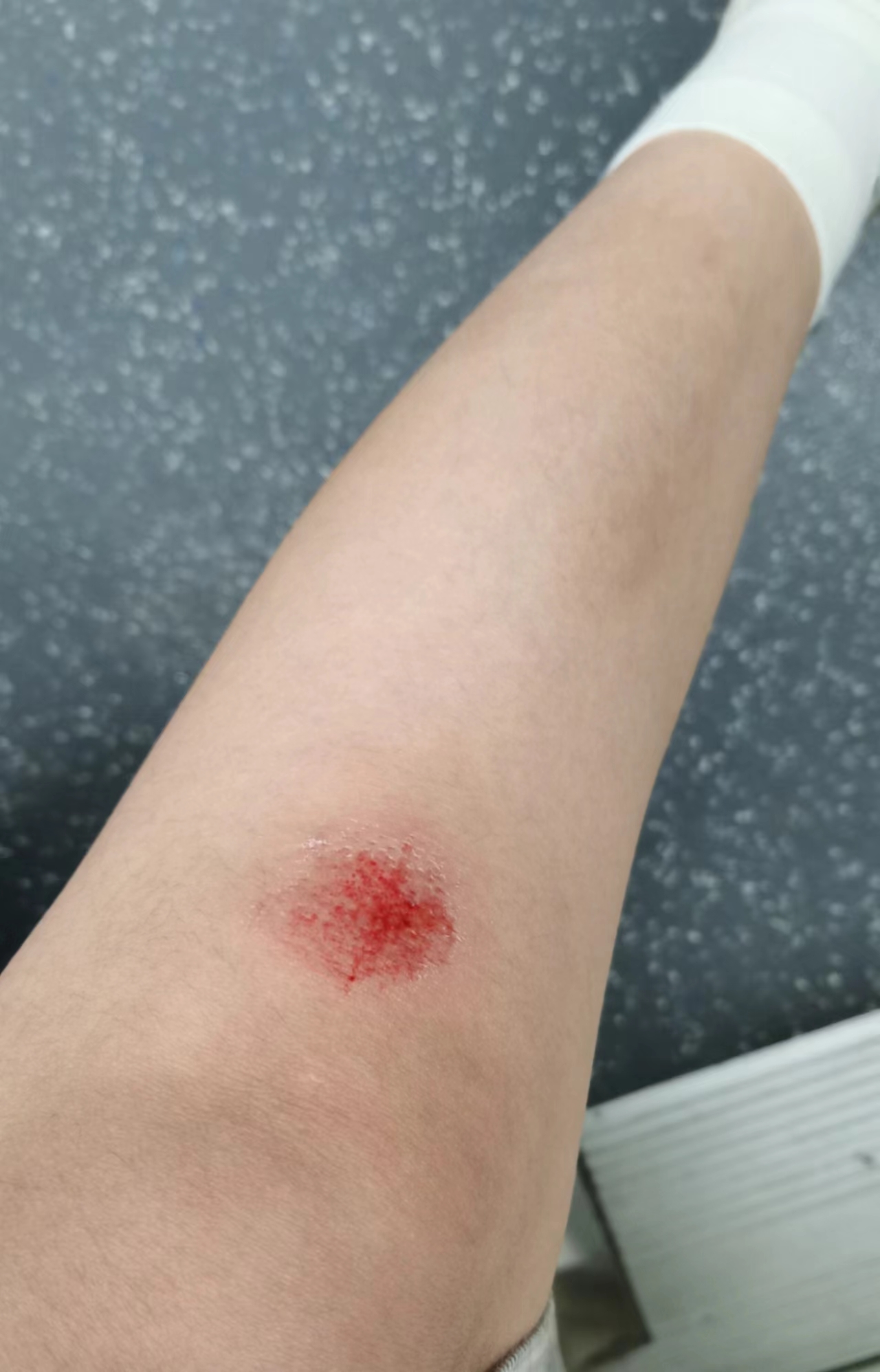 想象一下,第一天的时候或许只是一处皮外伤,看似无