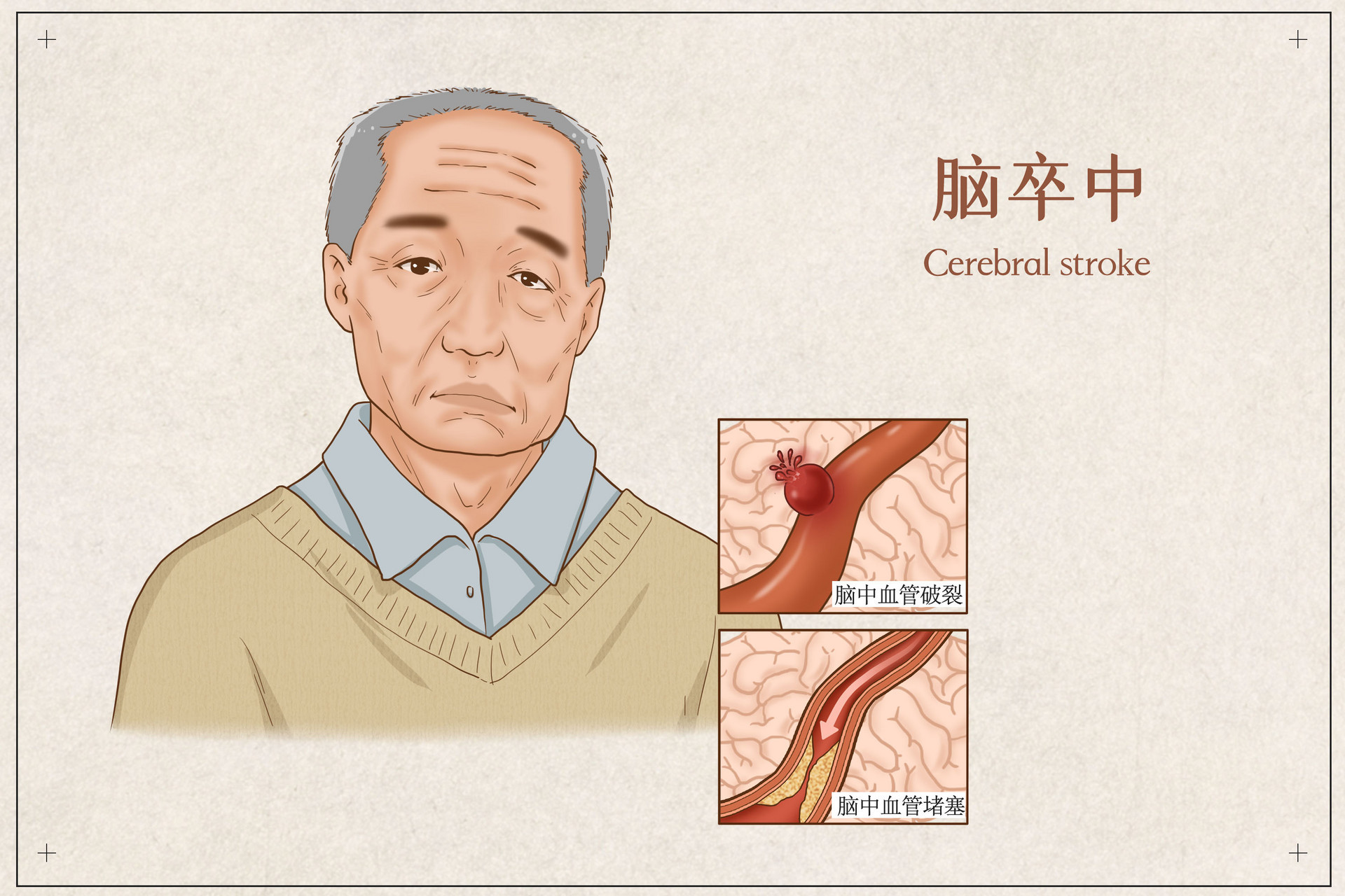 这5点快来看看#卒中# 卒中不受年龄限制,甚至可能在子宫内的婴儿身上