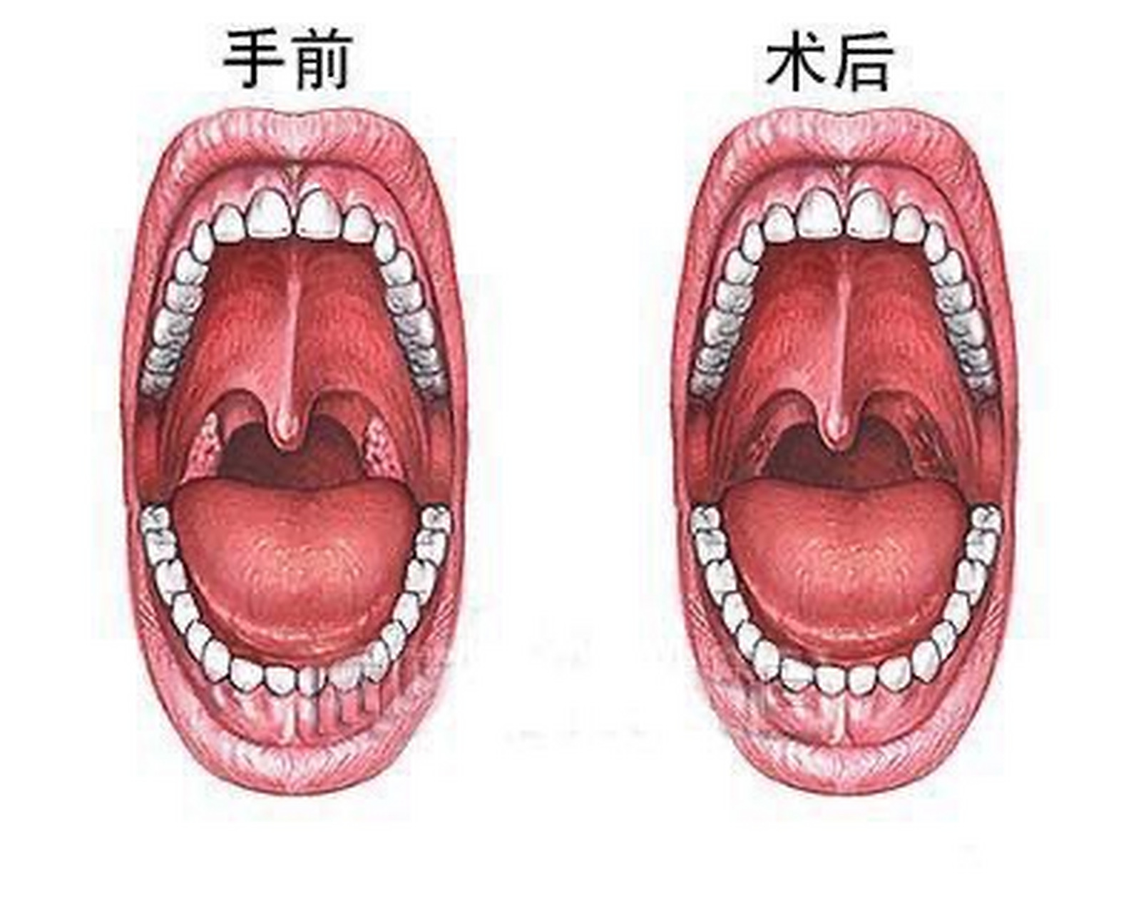 可能是扁桃體結石在作怪?醫生:有這些危害