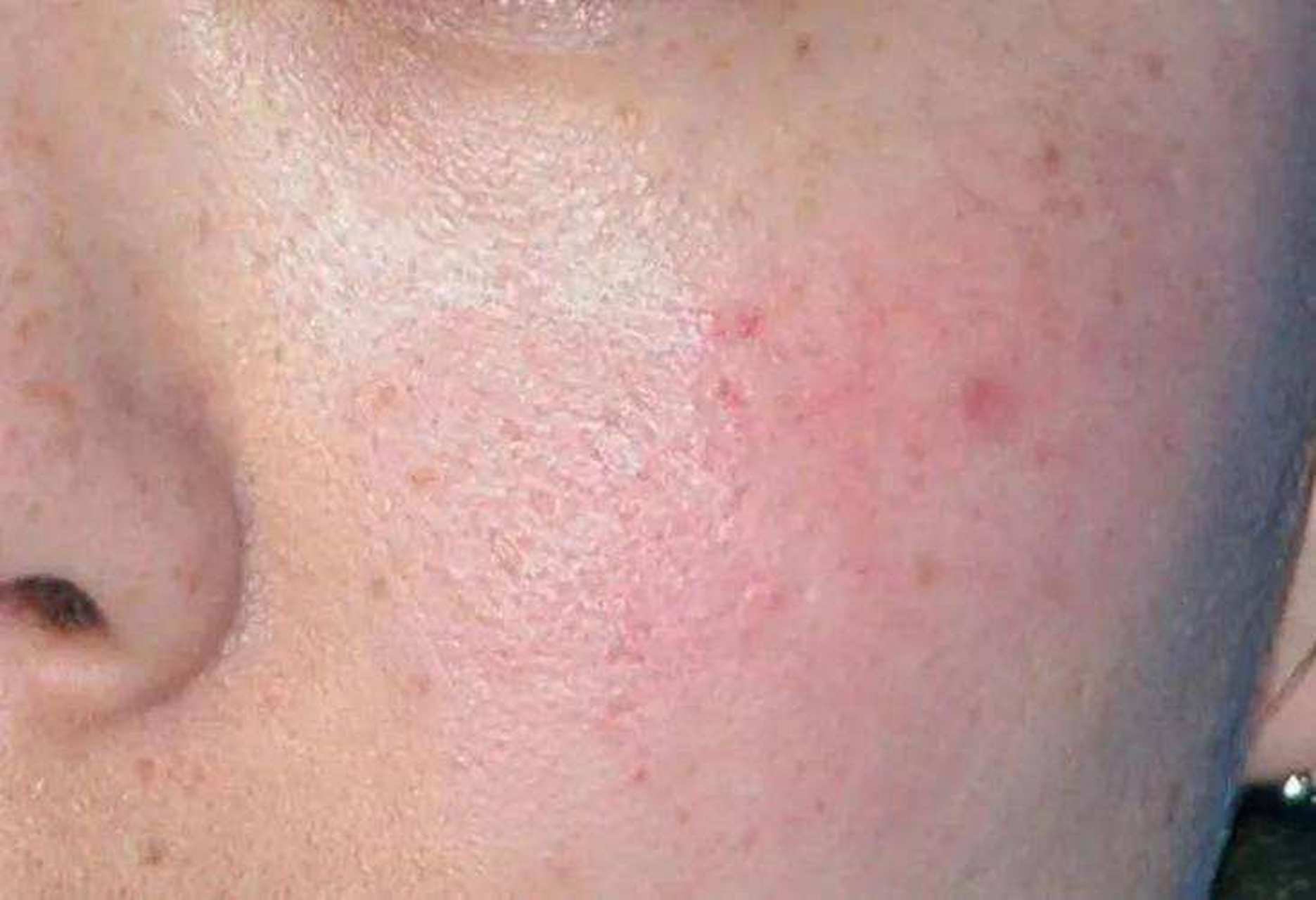 敷面膜脸上刺痛有灼烧感考虑可能是过敏,面部皮肤屏障功能受损,媚膜