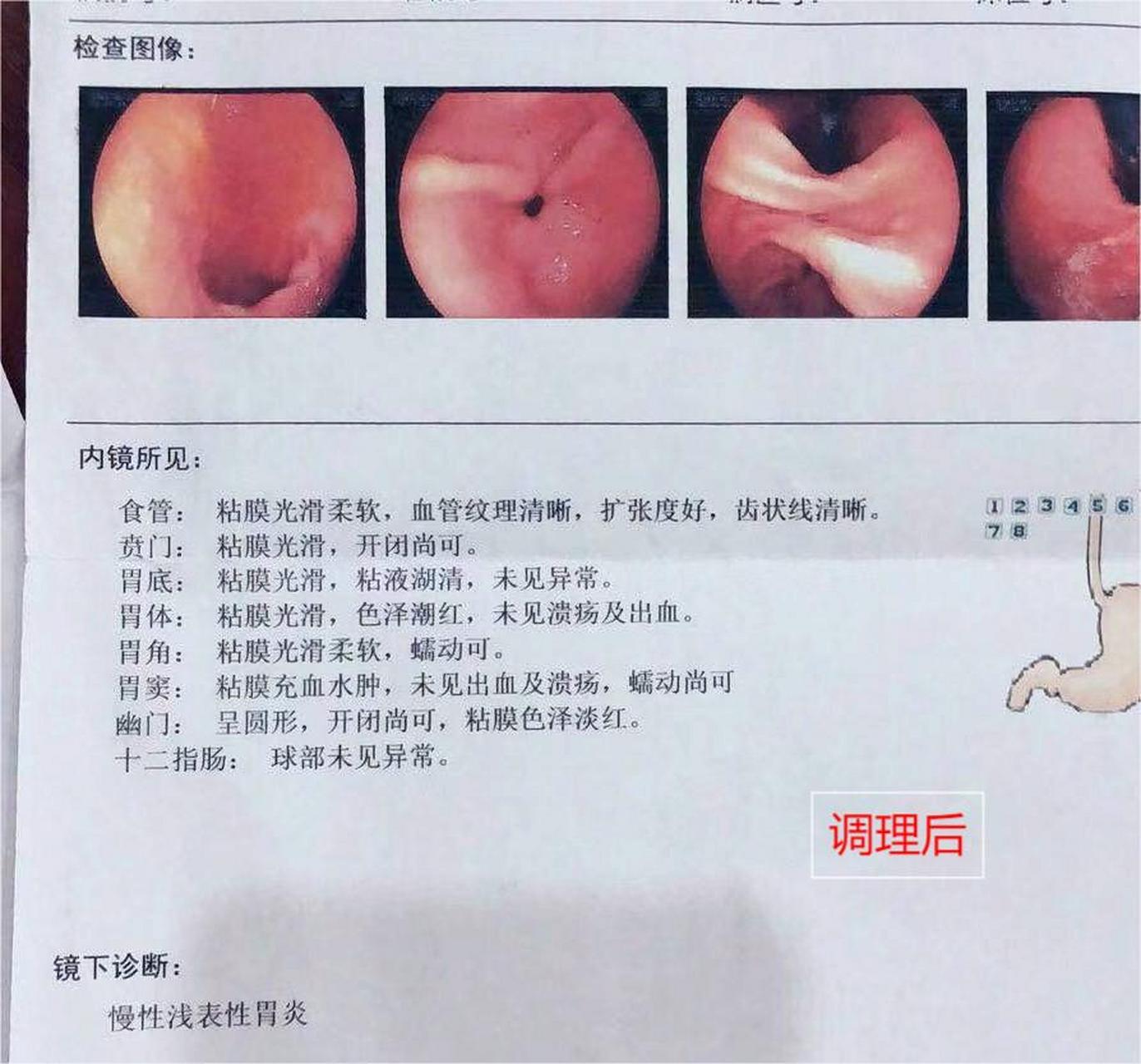 "去年十一月,胃镜确诊反流性食管炎,可能不太严重,吃了药好了.