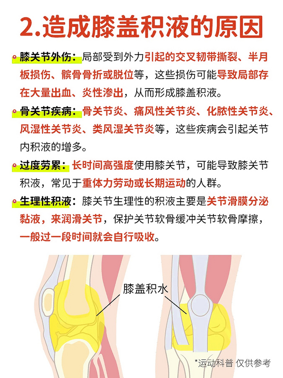 膝盖积液是常见的膝盖损伤之一 膝关节扭伤,感染,滑膜炎等 都有可能