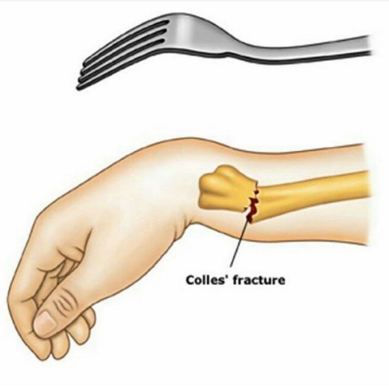 银叉畸形 ,看的手肘疼.