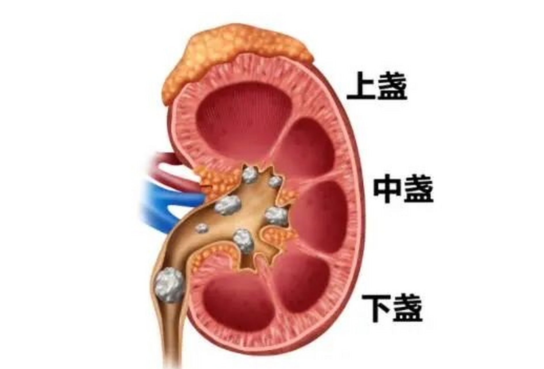 肾结石疼痛部位示意图图片