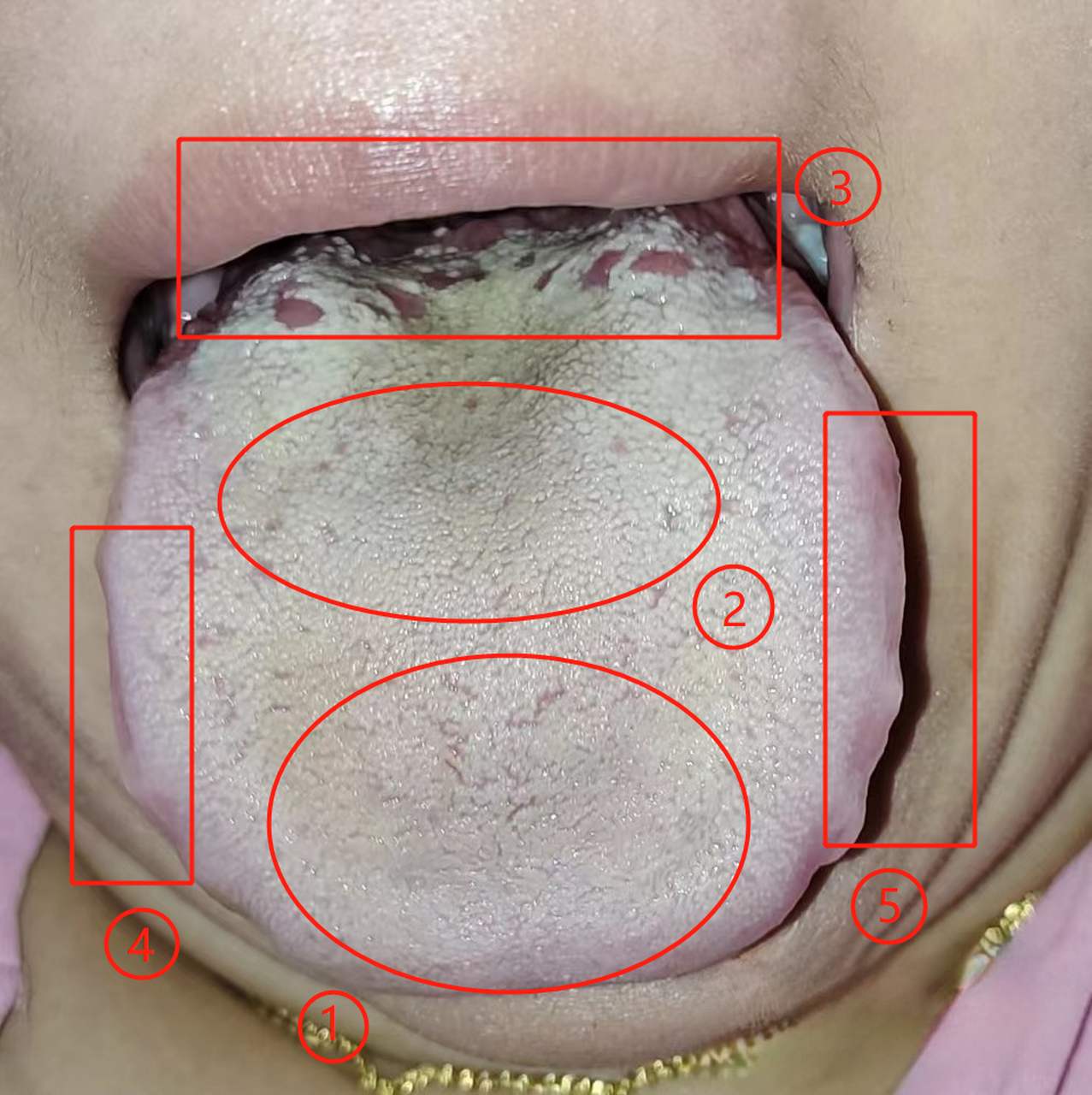 张医生教你看舌头,观舌知健康 主诉:子宫肌瘤囊肿,妇科炎症,食欲不振