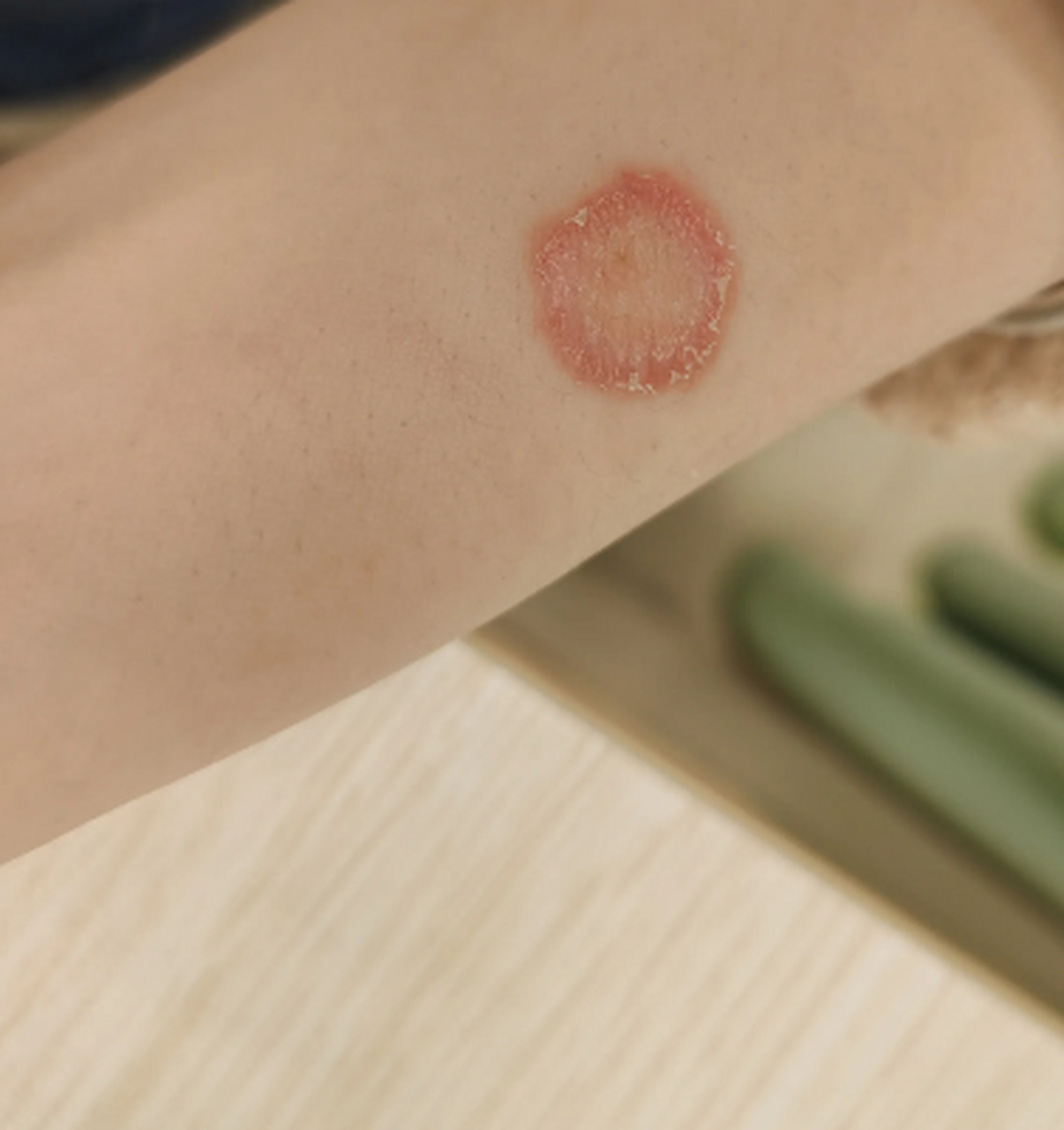 女子手臂上长了个圆圆的红圈圈,这是什么病?