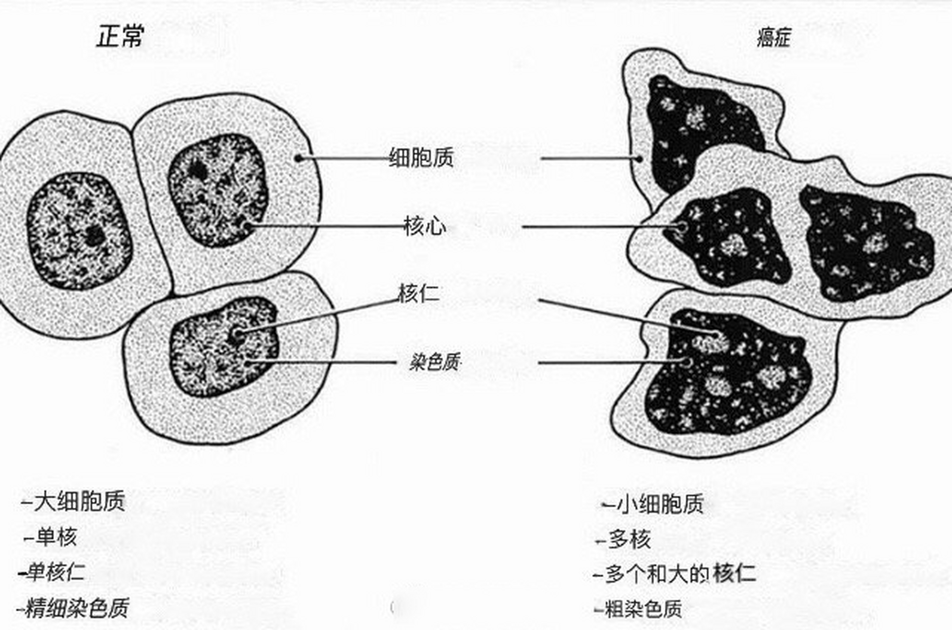 正常细胞和癌细胞的显微区别.