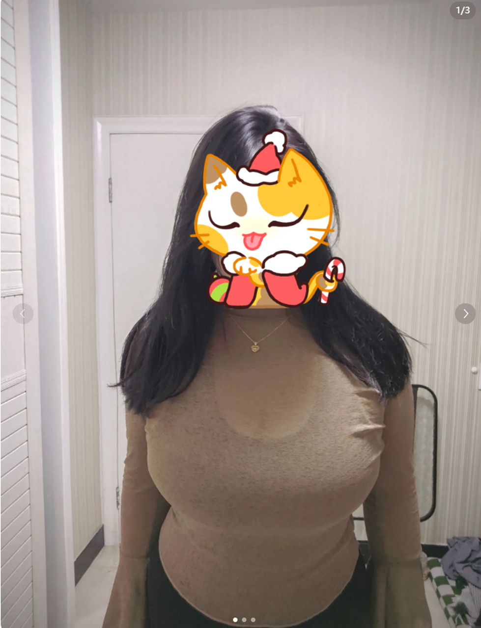 【求美者】27岁重度巨乳下垂,严重影响生活,伴随九年的负担缩胸摆脱