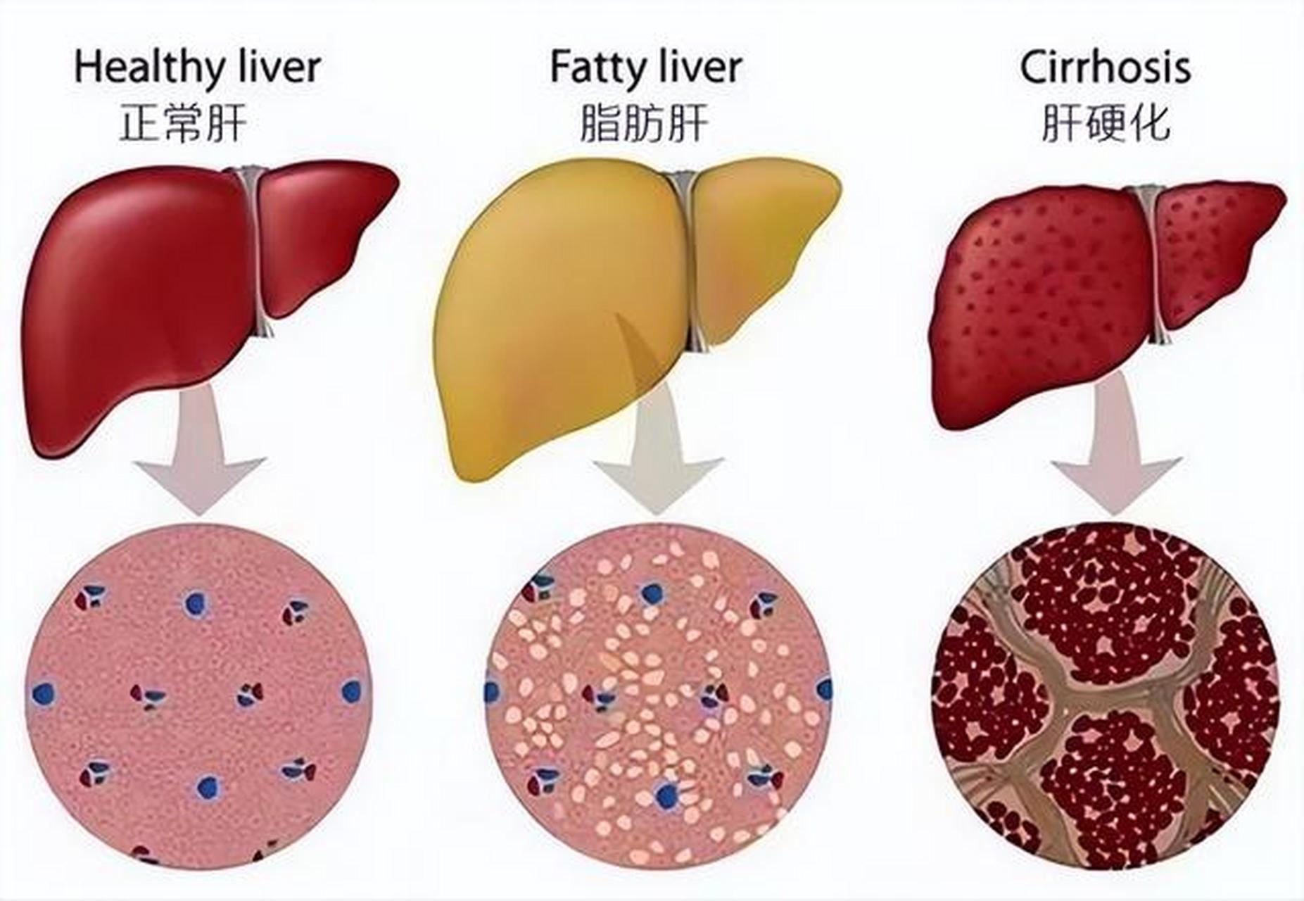 体检查出重度脂肪肝,以为没啥事,天天喝小酒,胡吃海喝,结果成了肝硬化