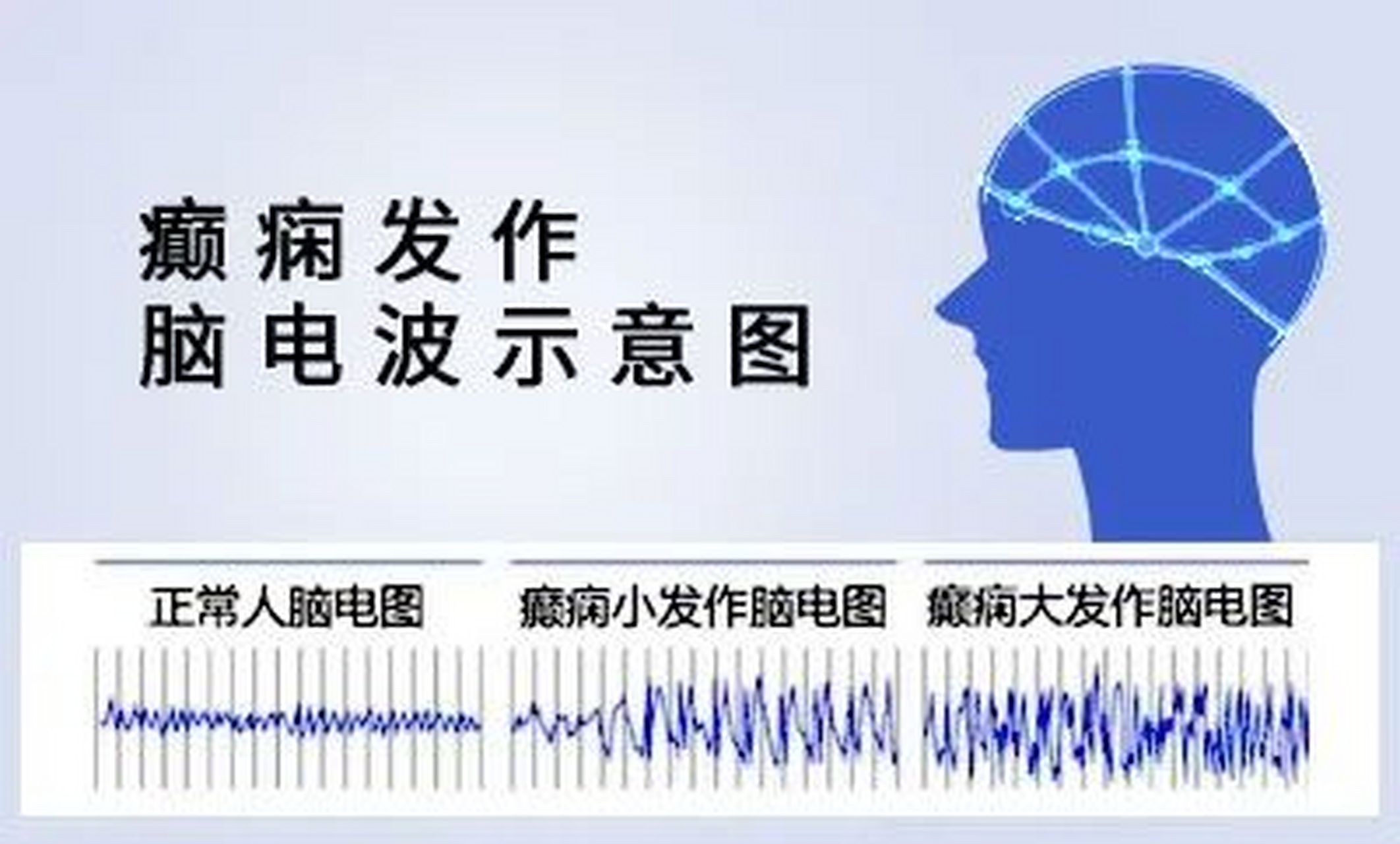 脑电图电极放置示意图图片