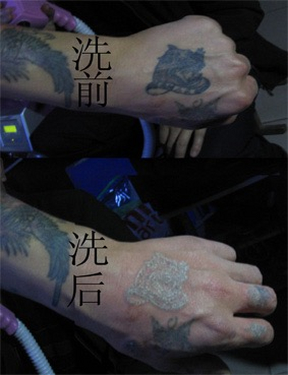 快速洗掉纹身方法主要是两种:分解法和破皮法.