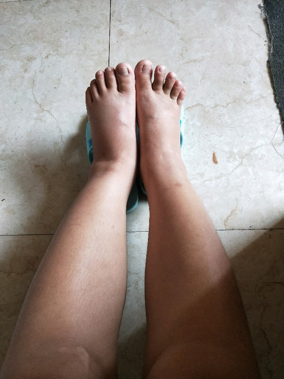 糖尿病患者下肢水肿难消,多半是阴阳两虚,痰瘀互阻,内服 外洗有效改善