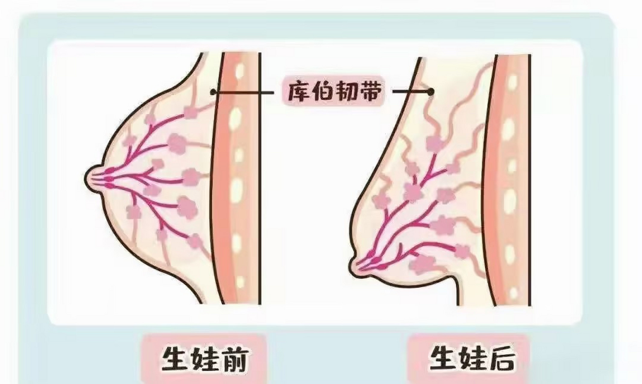 生孩子乳房下垂图片