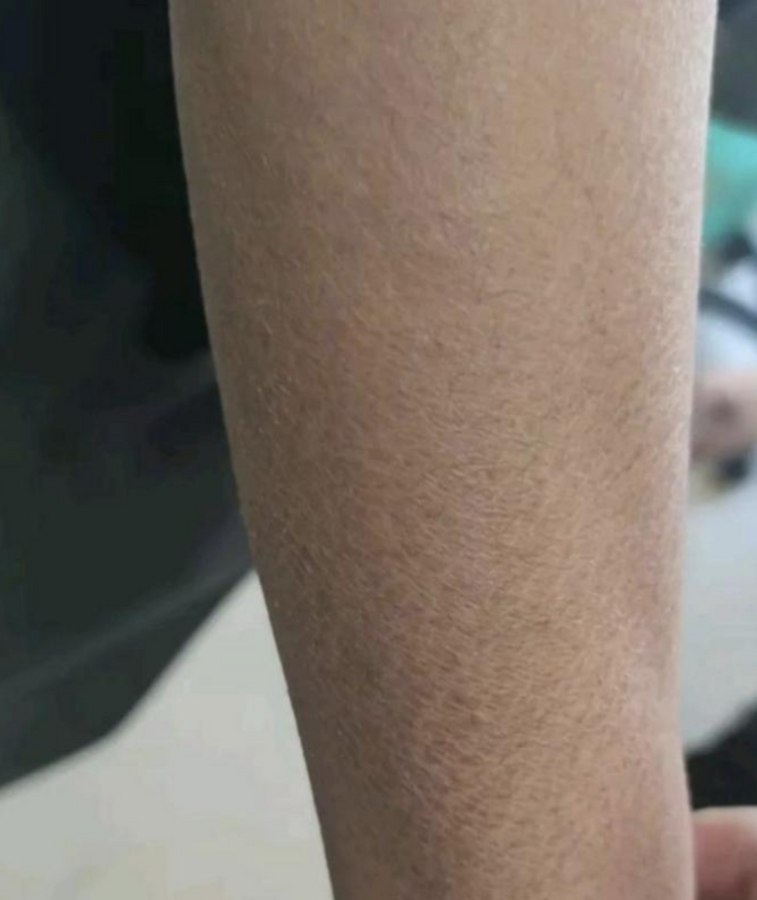 朋友腿上这样了,告诉我这是鱼鳞病,这病好治吗?