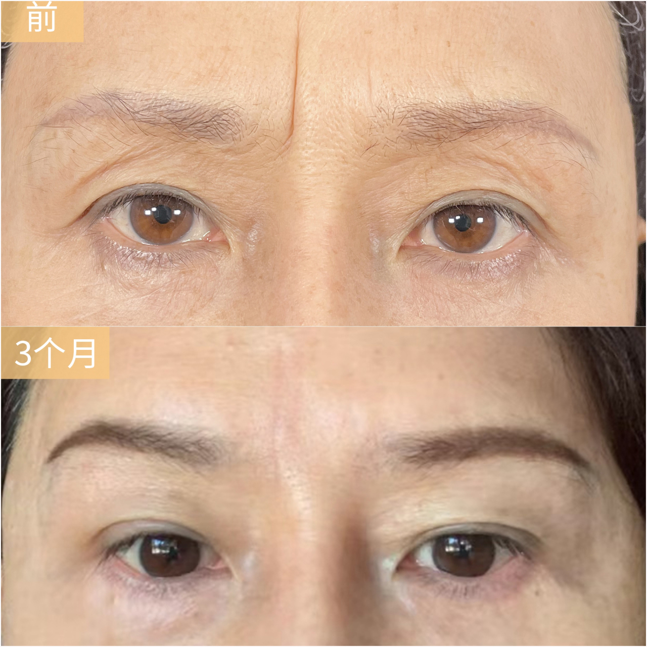 古人云:"印堂悬针纹粗显,刑夫斩子灾必见".