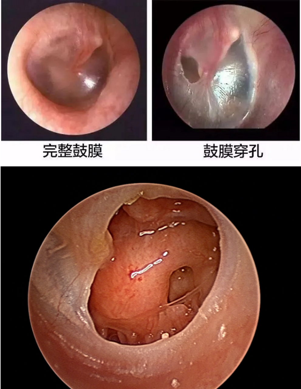 正常鼓膜耳镜图片图片