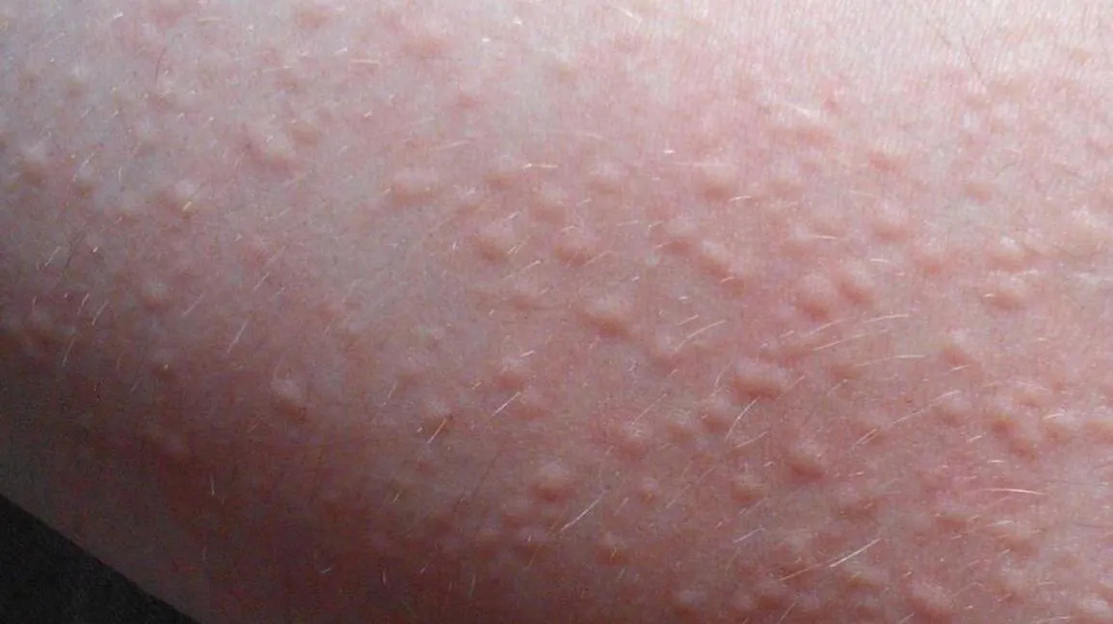 这属于【胆碱能性荨麻疹】 每次发作都是在运动,激动,受热后.