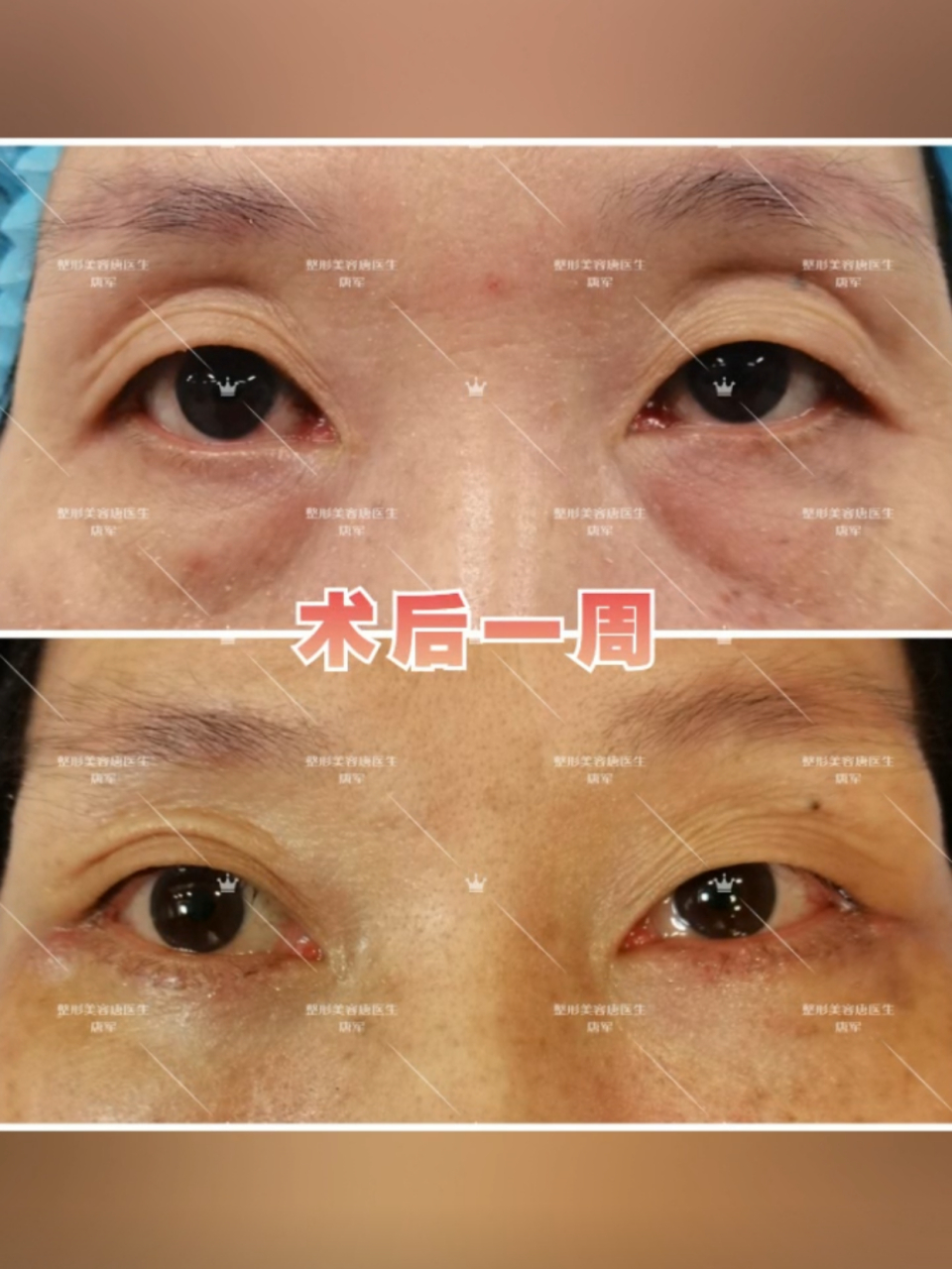 眼袋外切 术前:患者眼袋中度凸出伴泪沟凹陷,皮肤较薄,质地和弹性较差