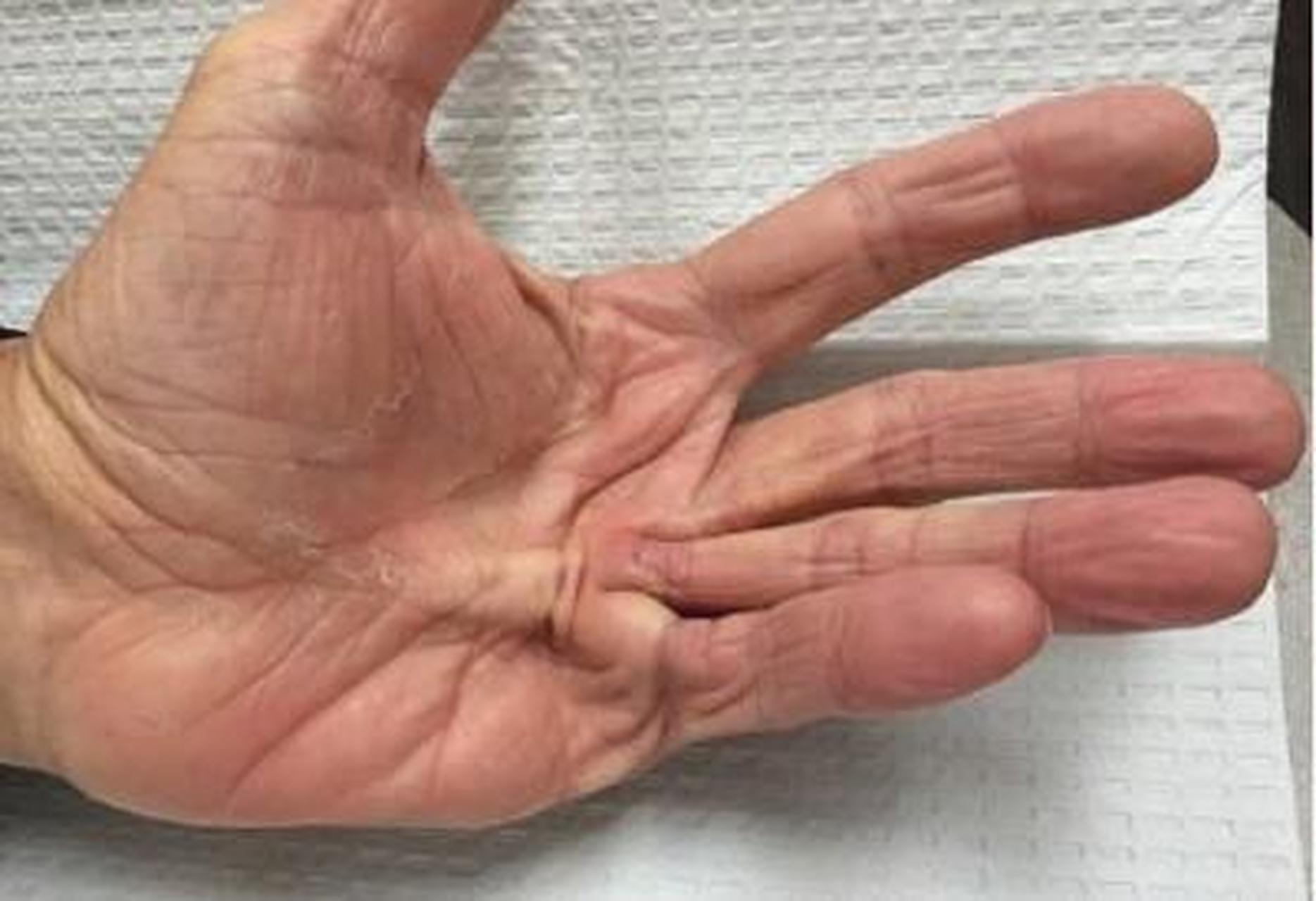 掌腱膜挛缩症,又称dupuytren挛缩.