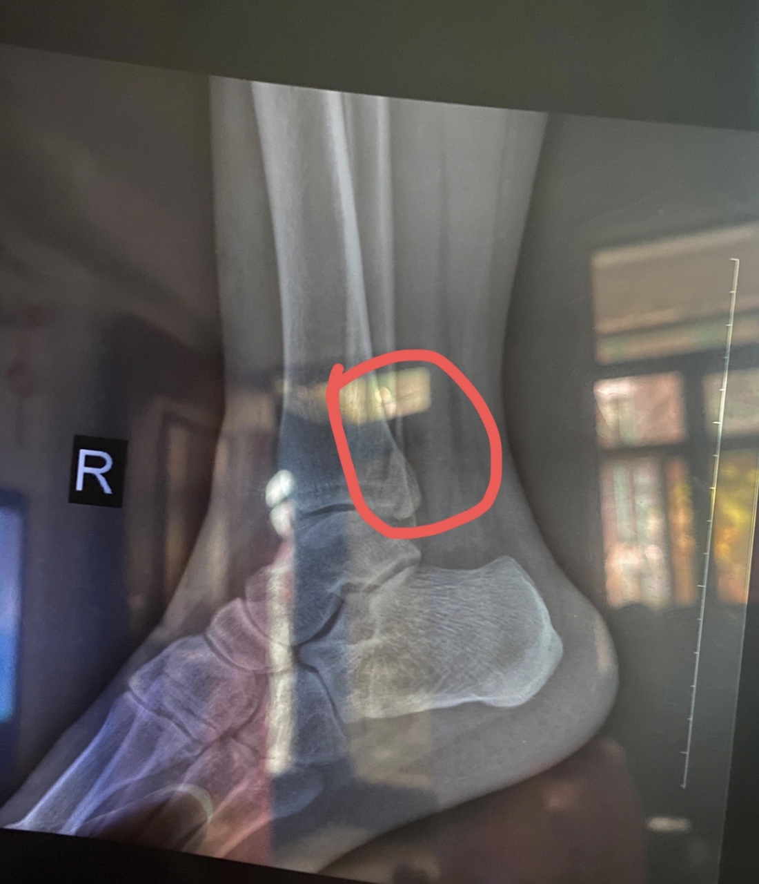 右外踝骨折记录恢复过程94  20223