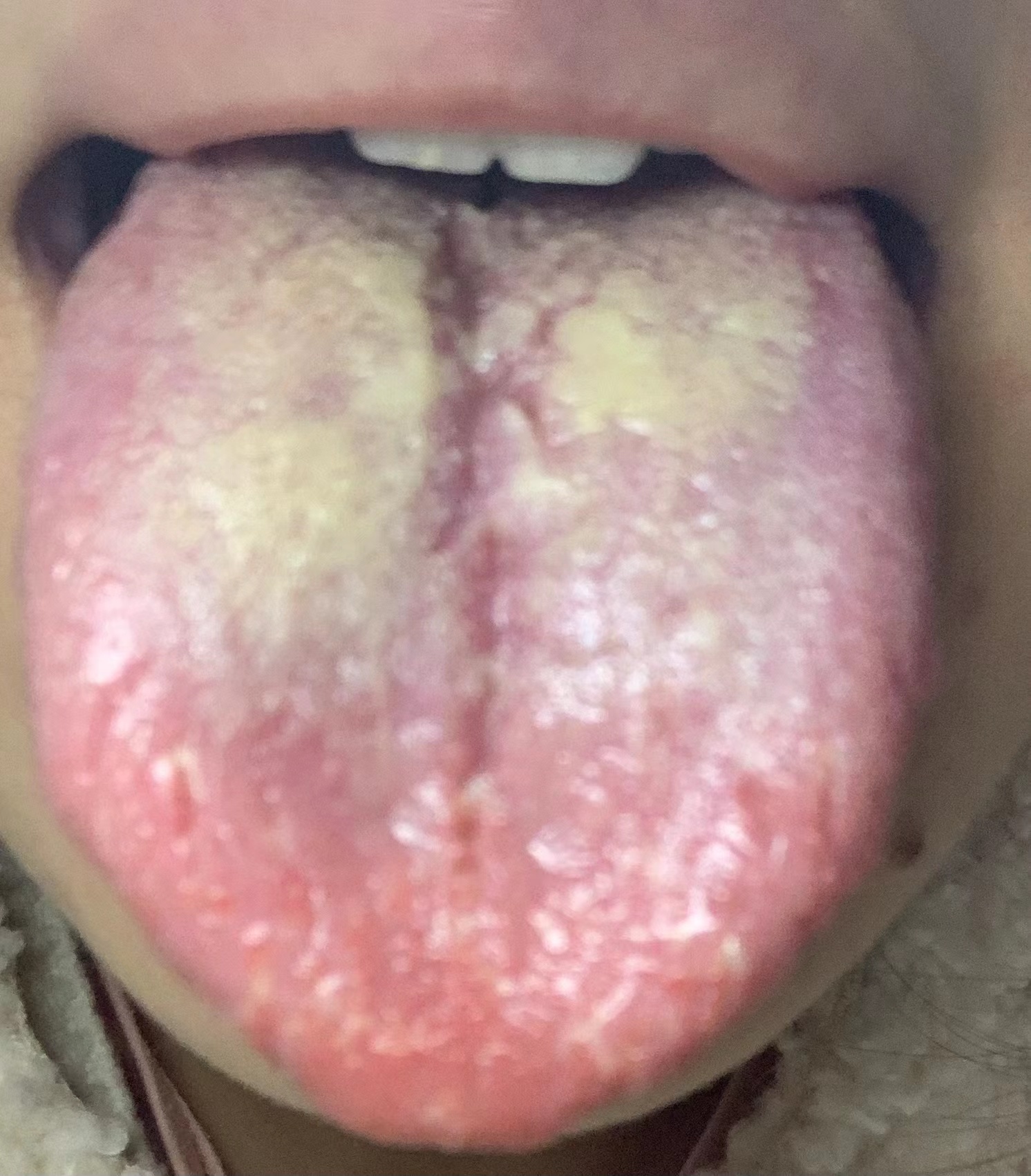 舌头有裂纹 会导致舌头火辣辣的疼吗?