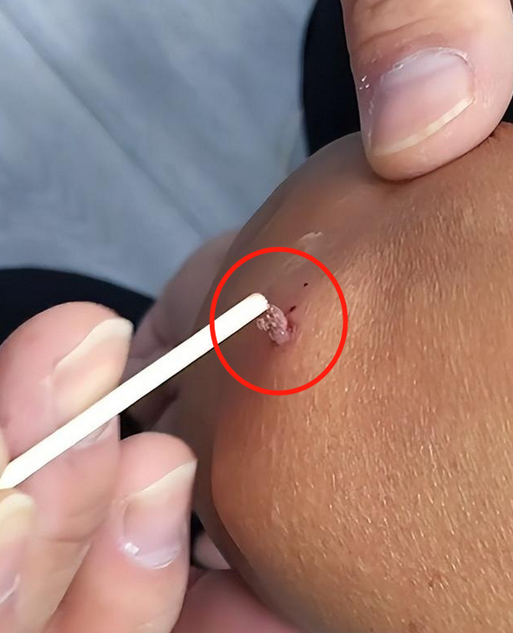 这种疣体,一般情况是不痛不痒的,但它会增大增多