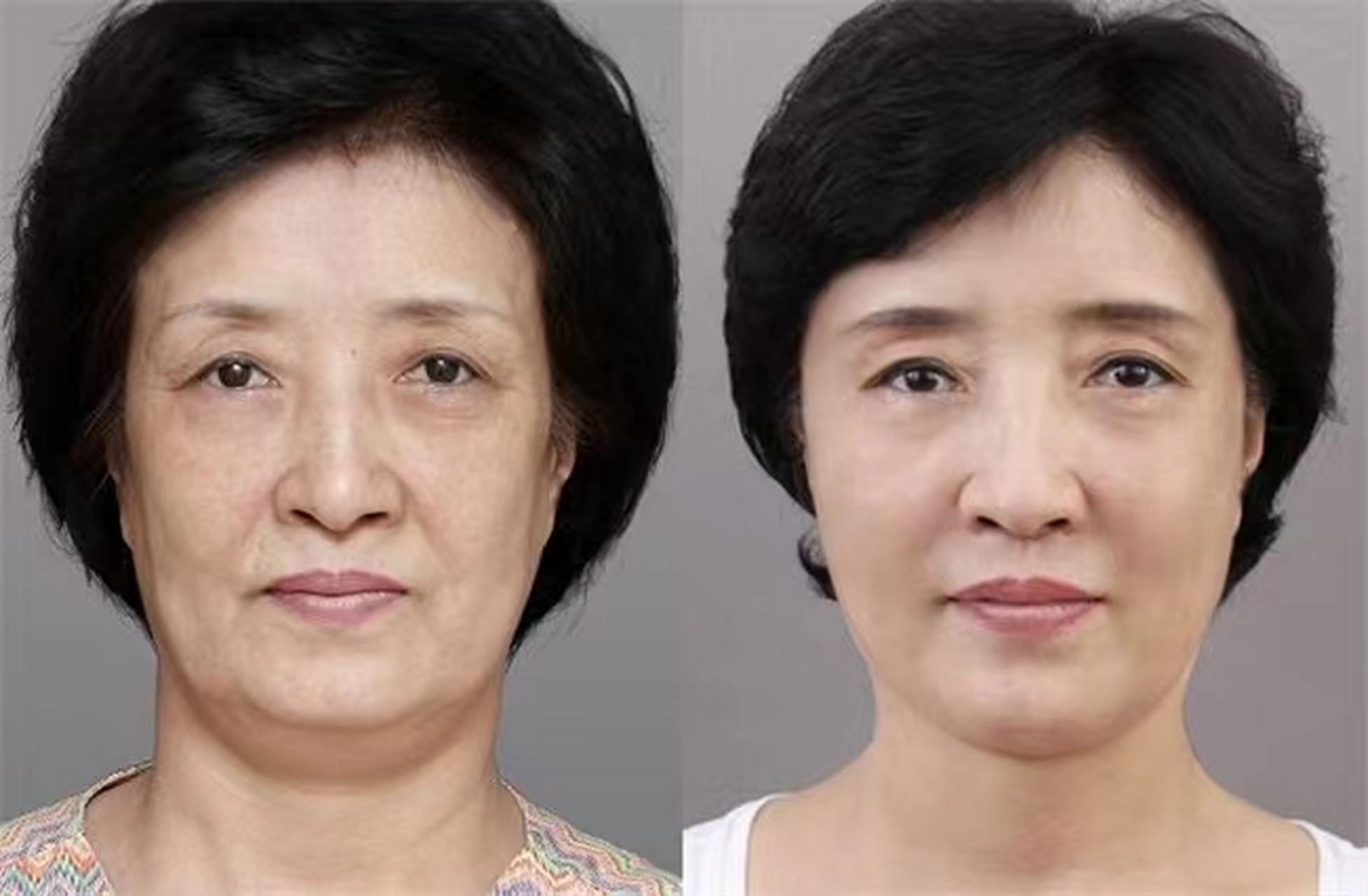 为什么做了那么多医美,还是改善不了皮肤松弛下垂的问题?