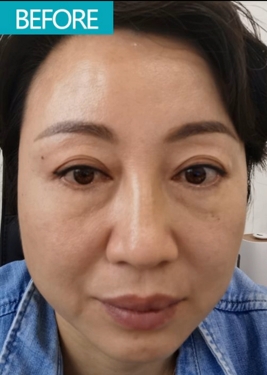 40 女性三次眼袋手术均失败,辗转遇到老路,第四次手术一次成功.