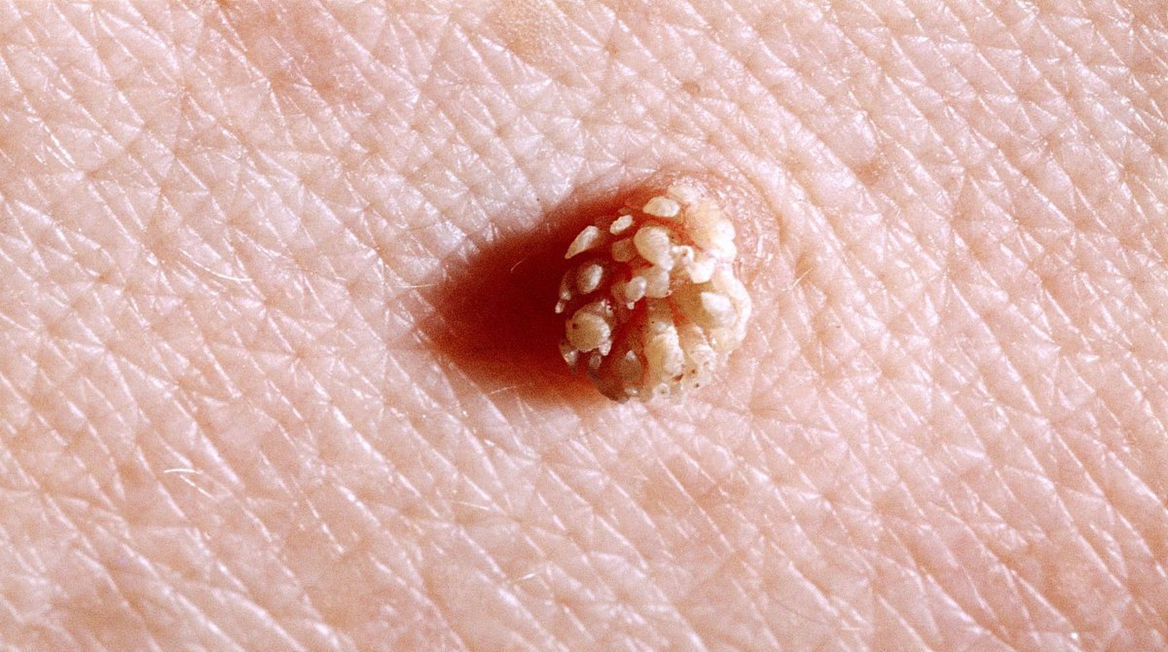 感染了hpv 会有什么表现?一定会长疣体吗?