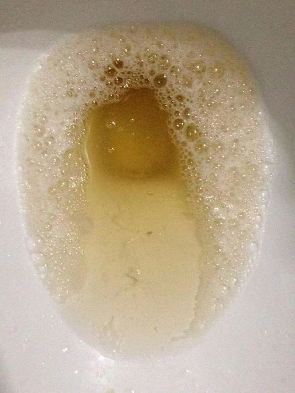 泡沫尿的图片 正常图片