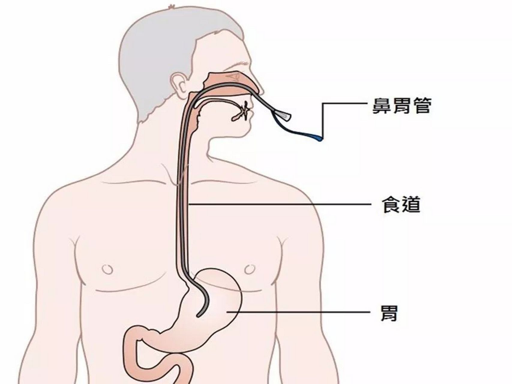 插胃管喉咙痛,该如何缓解?