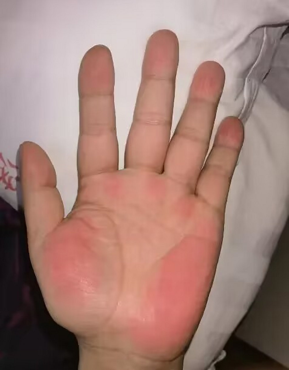 给大家看一下,图片上就是传说中的肝掌,可以明显的看出,双手手掌