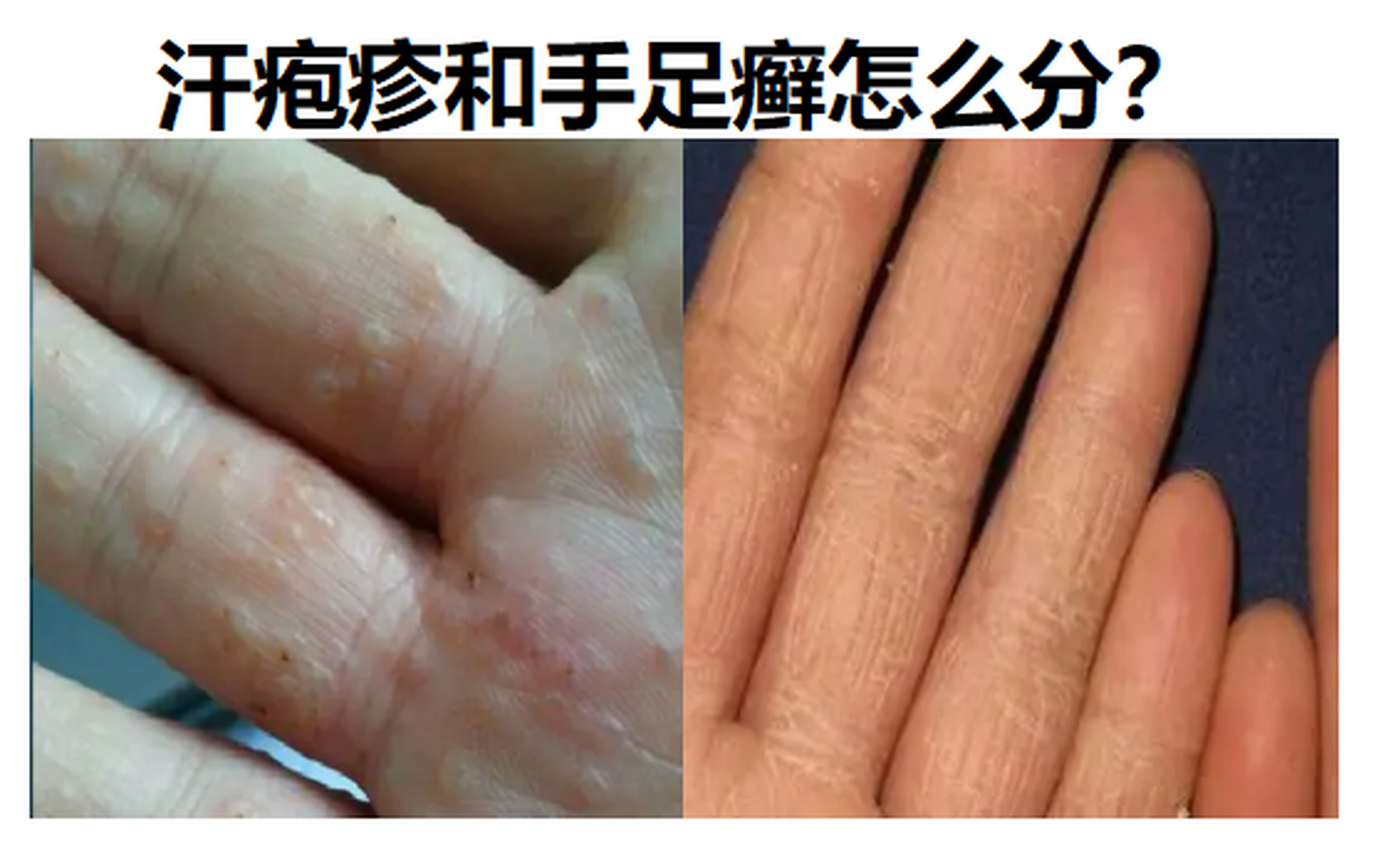 汗疱疹是一种变态反应性不会传染.手足癣会传染.