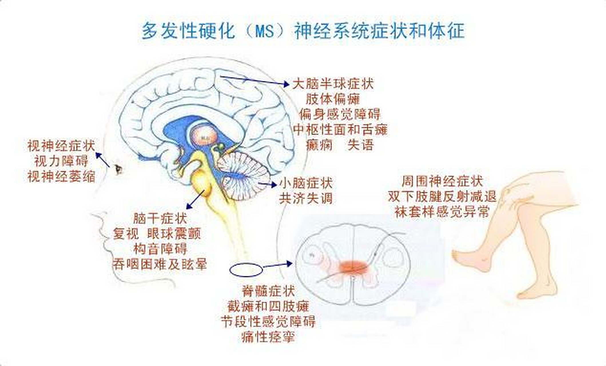 一,引言  多发性硬化症(multiple sclerosis,ms)是一种慢性疾病,其