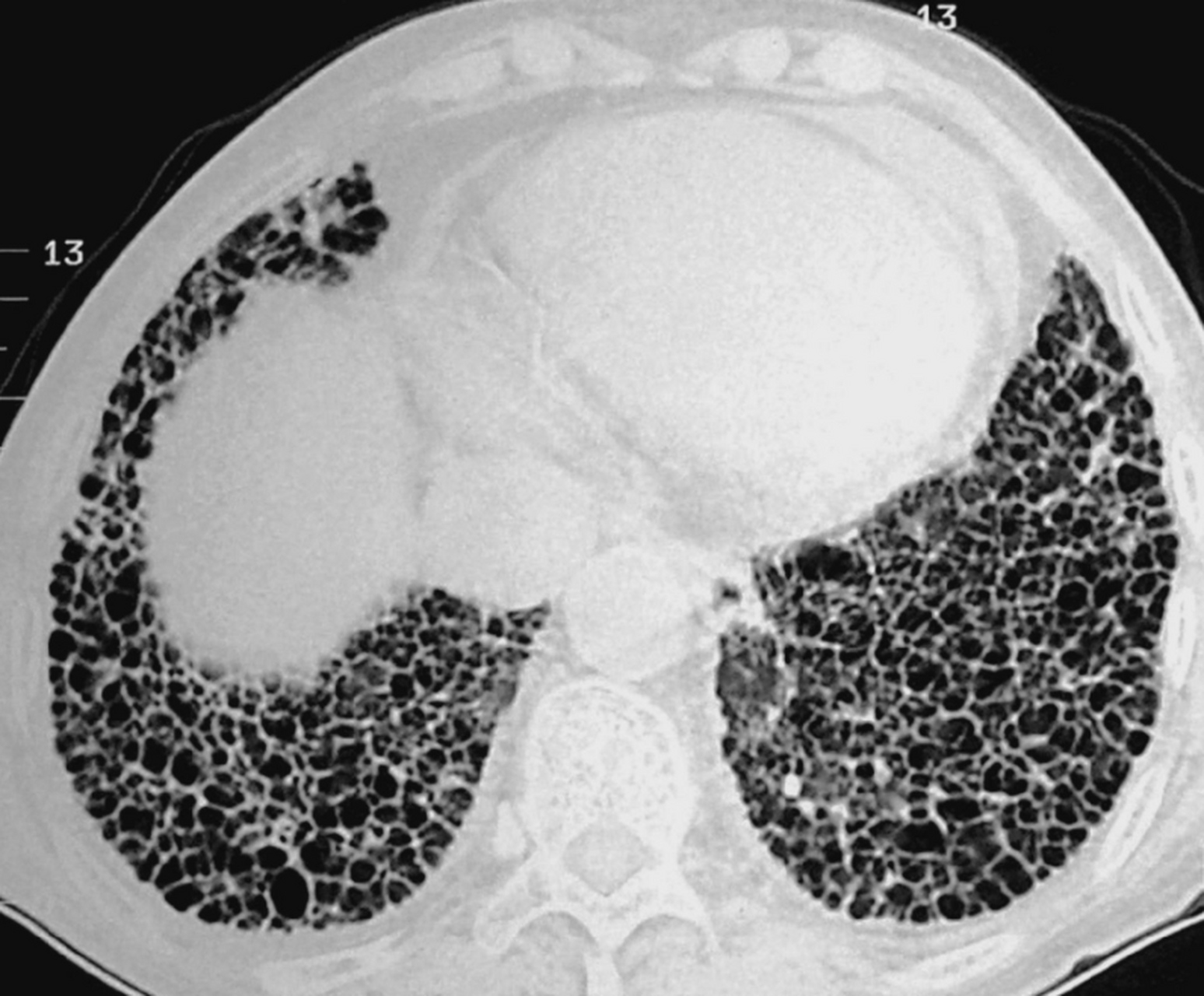 肺纤维化大部分可以逆转,少部分不可逆转,但能好转!