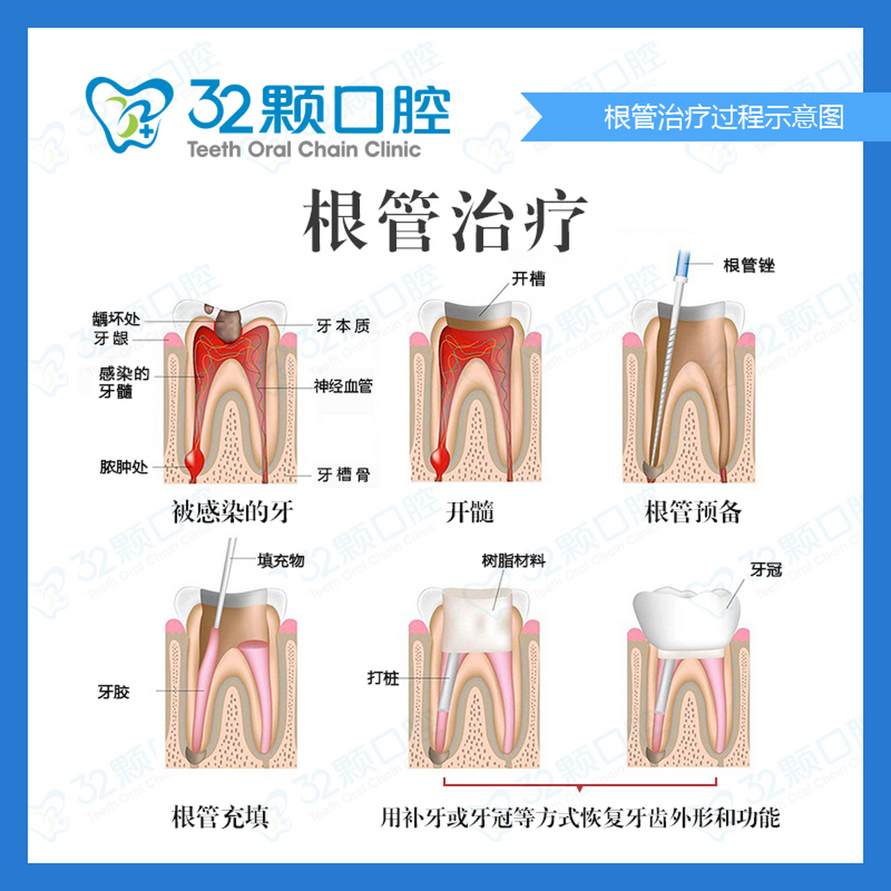 牙齿根管治疗分解图图片