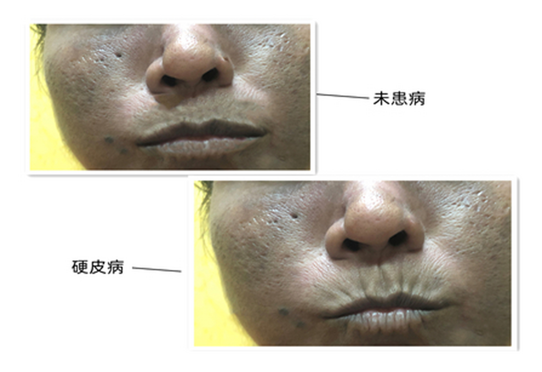 硬皮病嘴唇为什么会有皱纹?